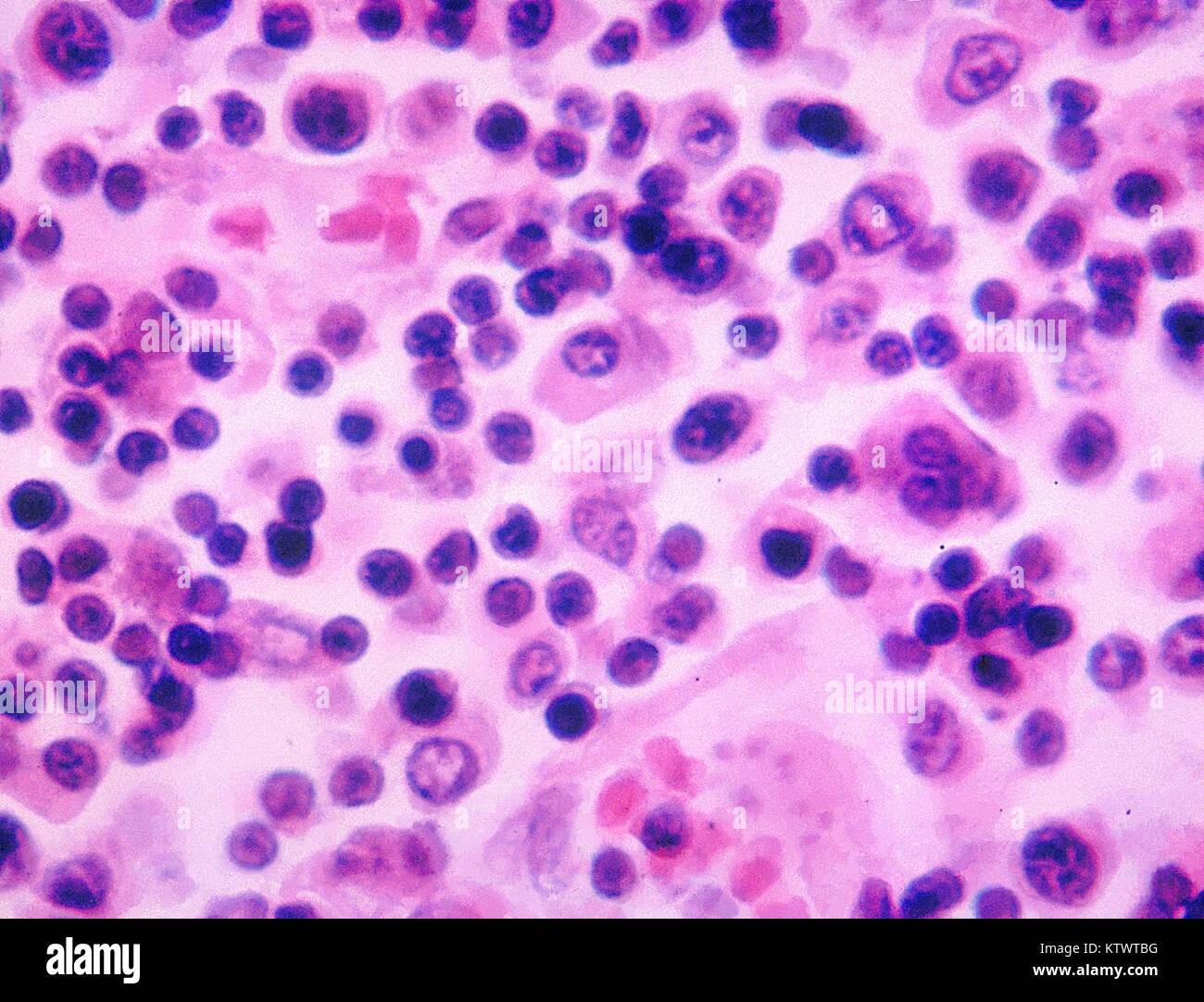 Histopathologie von einem Lymphknoten in einem Fall von Typhus. Nach anfänglich in kontaminierten Lebensmitteln wie Muscheln, oder Wasser eingenommen werden, Salmonella typhi Bakterien durch die Darmschleimhaut des Terminal ileum in der Submukosalen Lymphknoten migrieren. Mit freundlicher CDC/Streitkräfte Institut für Pathologie, Charles N. Bauer, 1964. Stockfoto