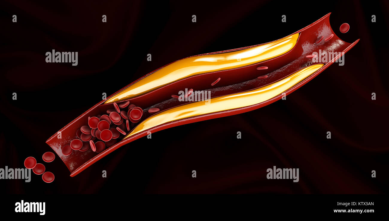 Arterie mit Cholesterin Anhaftungen realistische 3D-Darstellung. Stockfoto