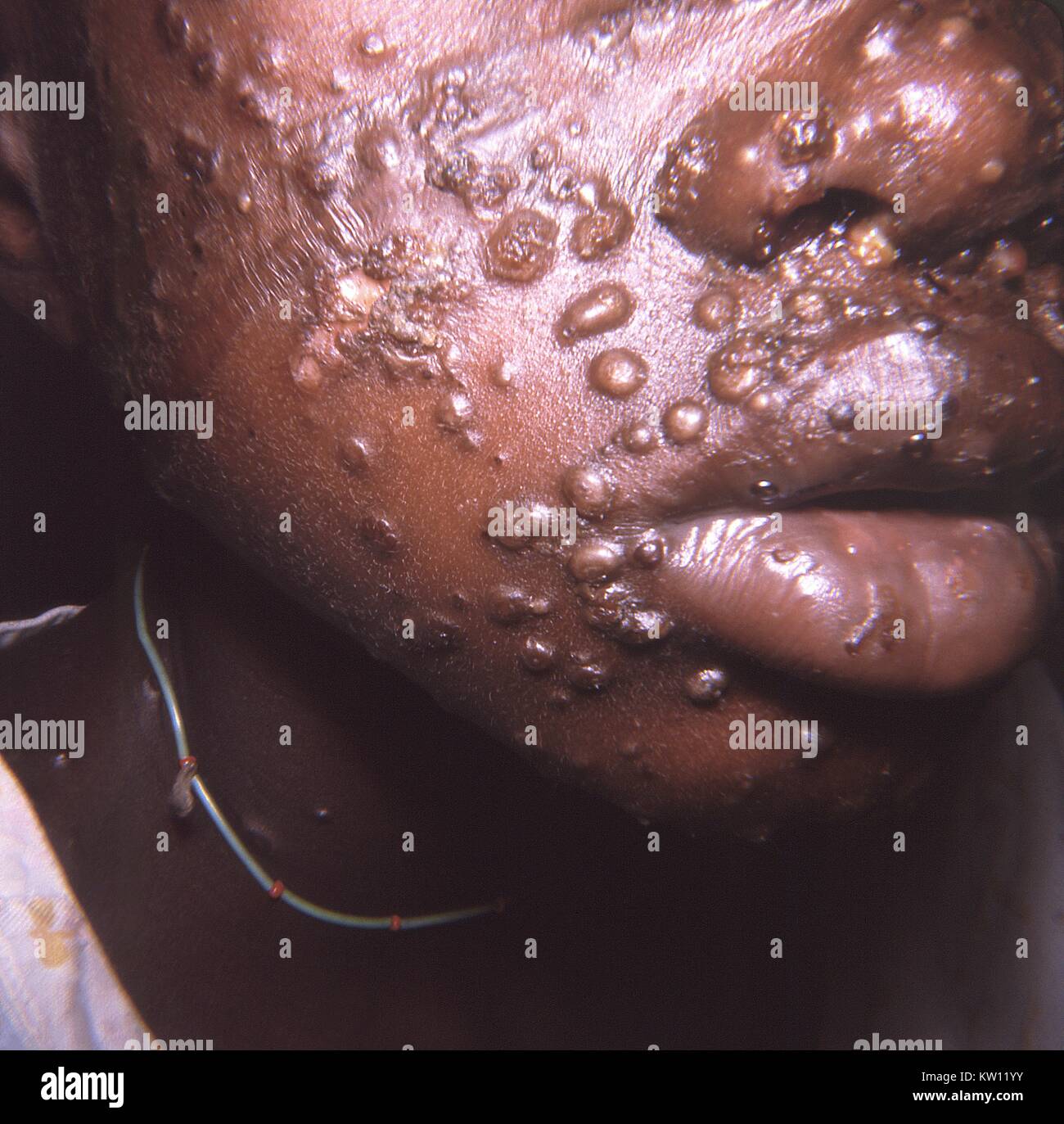 Nahaufnahme von Pocken Verletzungen auf dem Gesicht eines Patienten leben in Accra, Ghana, 1967. Die Streikbrecher wird schließlich fallen aus Spuren auf der Haut, Narben Löcher gebildet werden. Der Patient ist ansteckend auf andere, bis alle Krusten abgefallen sind. Bild mit freundlicher Genehmigung von CDC/Dr. J. in der edlen Jr, 1967. Stockfoto