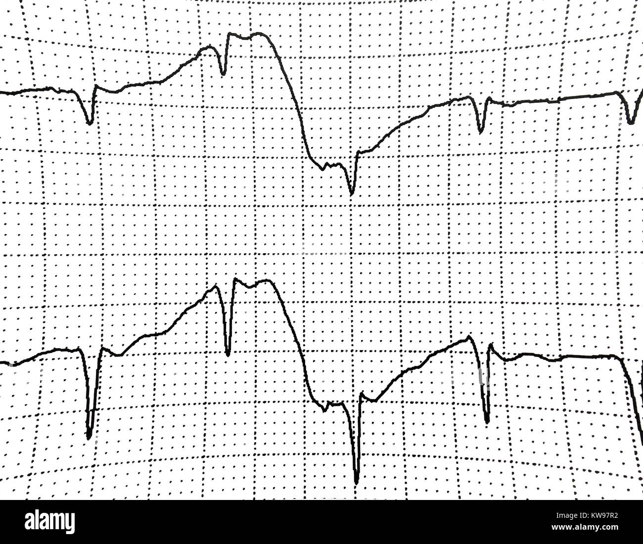 Ekg-Test zeigt, dass die elektrische Aktivität des Herzens Stockfoto