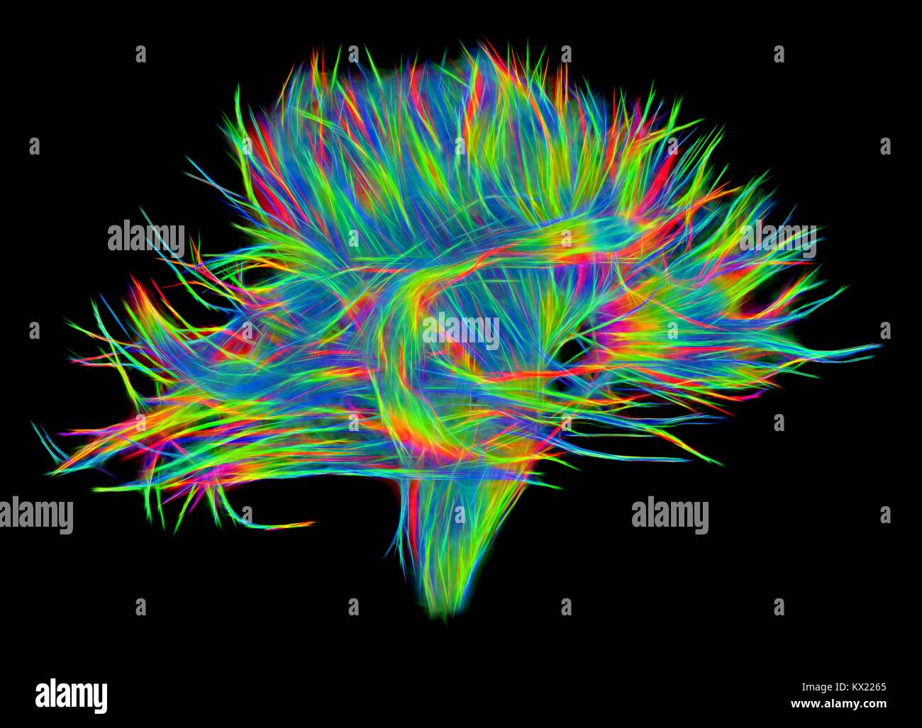 Weißer Fasern. Computer verbesserte 3D-Diffusion Spectral Imaging (DSI) Scan der Bündel von weißer Substanz Nervenfasern im Gehirn. Die Fasern nervensignale zwischen Gehirn Regionen übertragen und zwischen dem Gehirn und dem Rückenmark. Diffusion Spektrum der Bildgebung (DSI) ist eine Variante der Magnetresonanztomographie (MRT), in die ein magnetisches Feld bildet die Wasser in Neuron Fasern enthalten, damit Karten ihrer Criss-crossing Patterns. Eine ähnliche Technik namens Diffusion Tensor Imaging (DTI) wird auch verwendet, um neuronale Daten der Fasern, die in der weißen Substanz des Gehirns zu erforschen. Beide Methoden ermöglichen die Zuordnung Ihrer Stockfoto