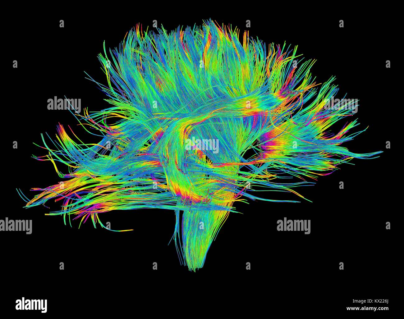 Weißer Fasern. Computer verbesserte 3D-Diffusion Spectral Imaging (DSI) Scan der Bündel von weißer Substanz Nervenfasern im Gehirn. Die Fasern nervensignale zwischen Gehirn Regionen übertragen und zwischen dem Gehirn und dem Rückenmark. Diffusion Spektrum der Bildgebung (DSI) ist eine Variante der Magnetresonanztomographie (MRT), in die ein magnetisches Feld bildet die Wasser in Neuron Fasern enthalten, damit Karten ihrer Criss-crossing Patterns. Eine ähnliche Technik namens Diffusion Tensor Imaging (DTI) wird auch verwendet, um neuronale Daten der Fasern, die in der weißen Substanz des Gehirns zu erforschen. Beide Methoden ermöglichen die Zuordnung Ihrer Stockfoto