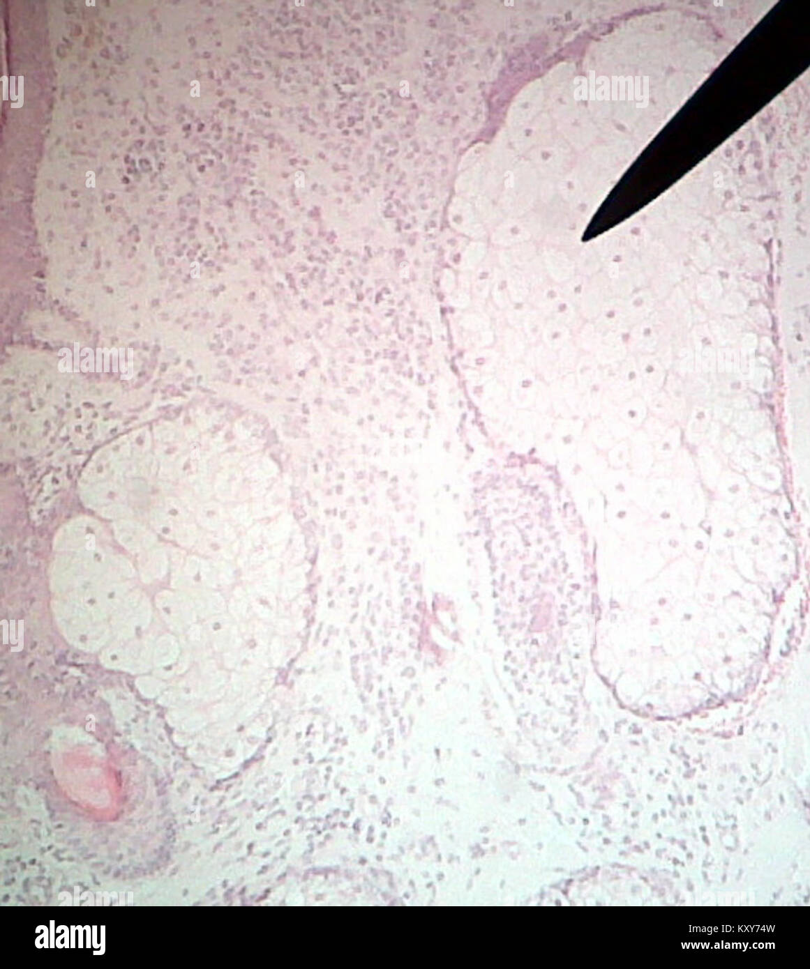 Mikroskopisches Bild der Talgdrüse, Teil der menschlichen Hautstruktur, verantwortlich für die Talgsekretion. Die Drüse ist wichtig bei der Erhaltung der Haut Schmierung und Gesundheit. Stockfoto