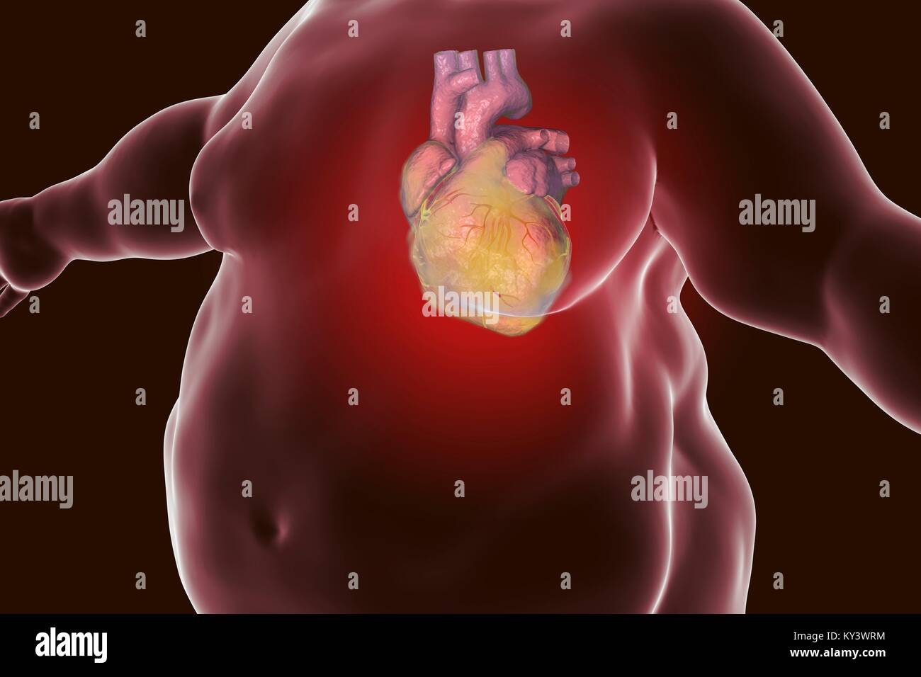 Computer Abbildung eines Fettsäuren Herz in einem übergewichtigen Menschen. Stockfoto