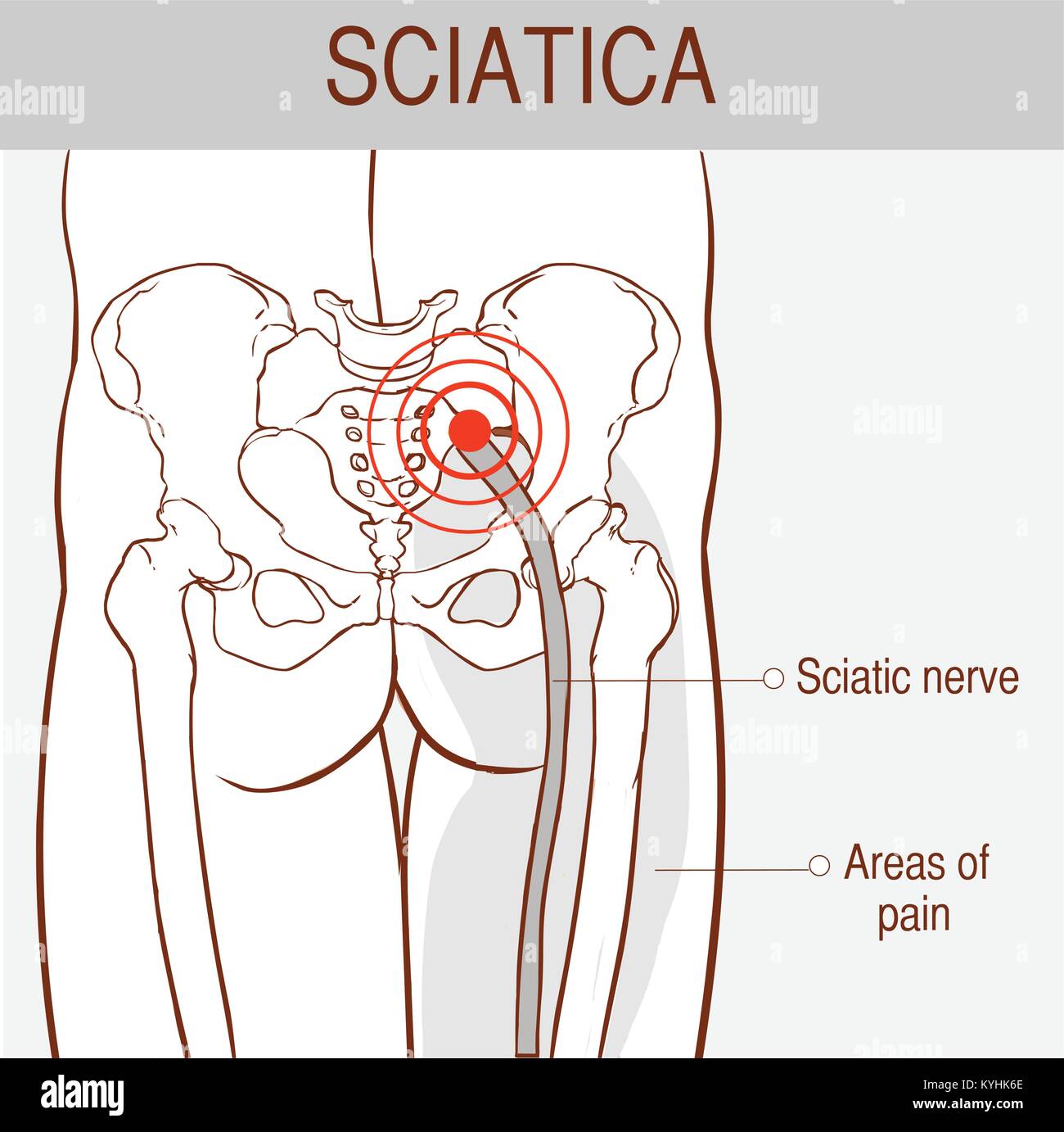 Vector Illustration eines Symptome von Ischias Stock Vektor