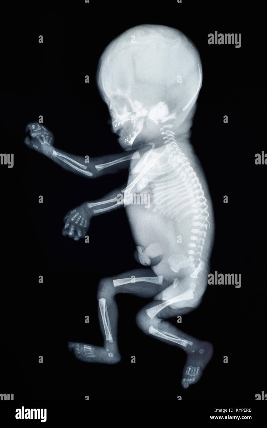 X-ray von einem Baby, Seitenansicht Stockfoto