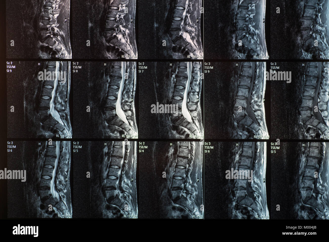 Magnetische resonanz Bild der menschlichen Wirbelsäule mit Lordose, Bandscheibenvorfall und Spondylolisthesis L5-S1 Stockfoto