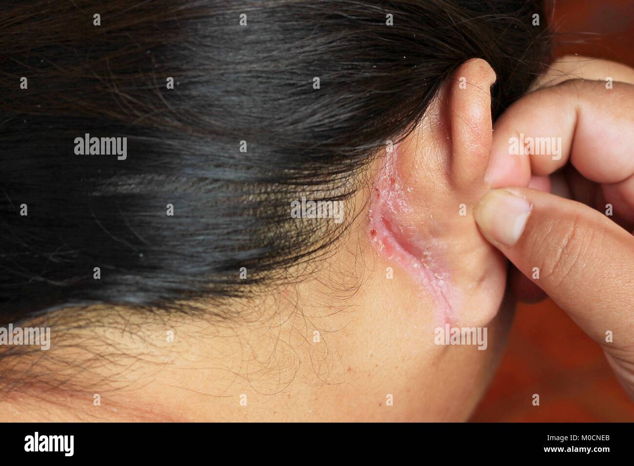 Für Ohrinfektionen Stockfotos und -bilder Kaufen - Alamy