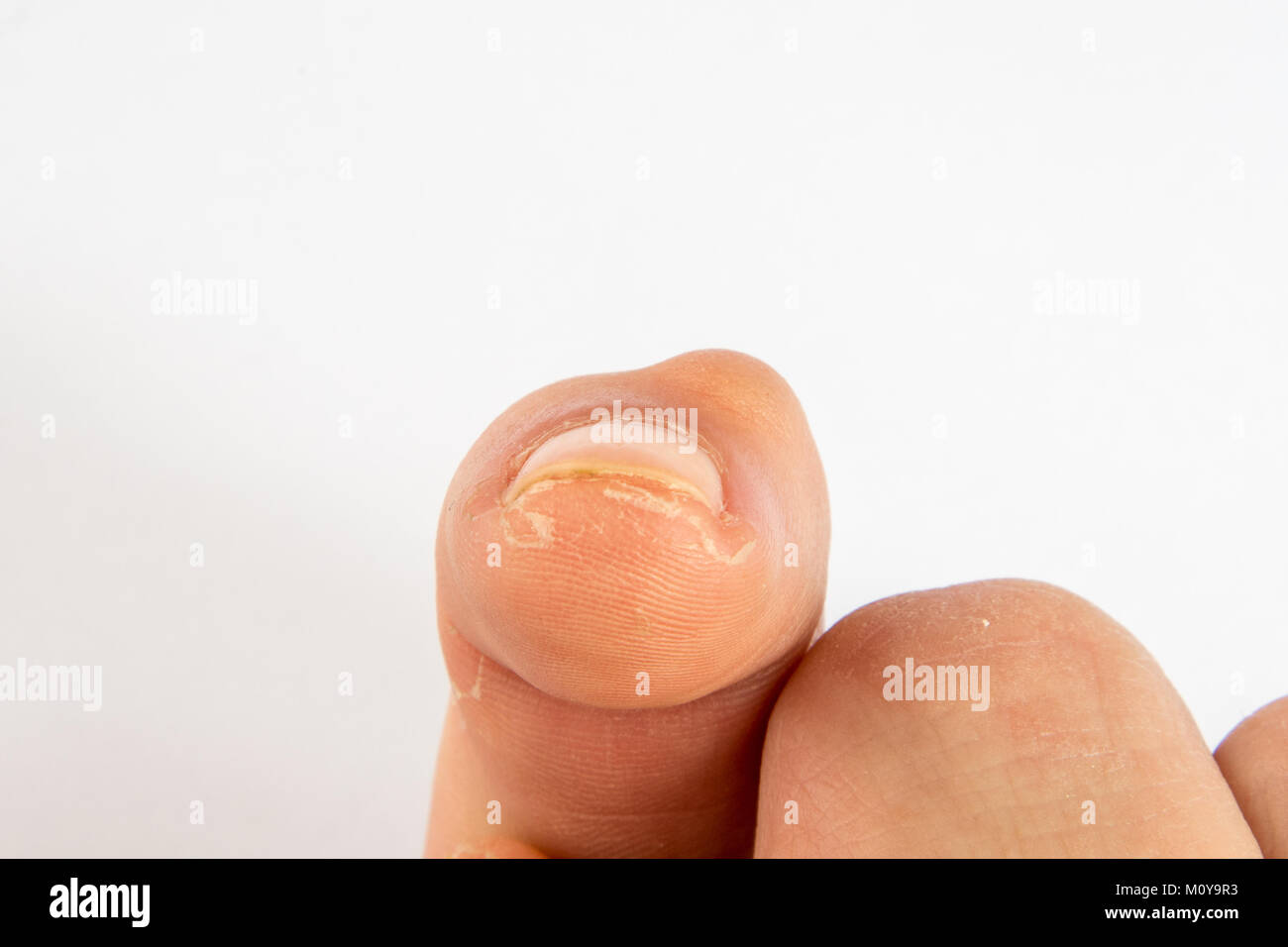 Ganglion Zysten wachsen auf einem Finger Stockfoto