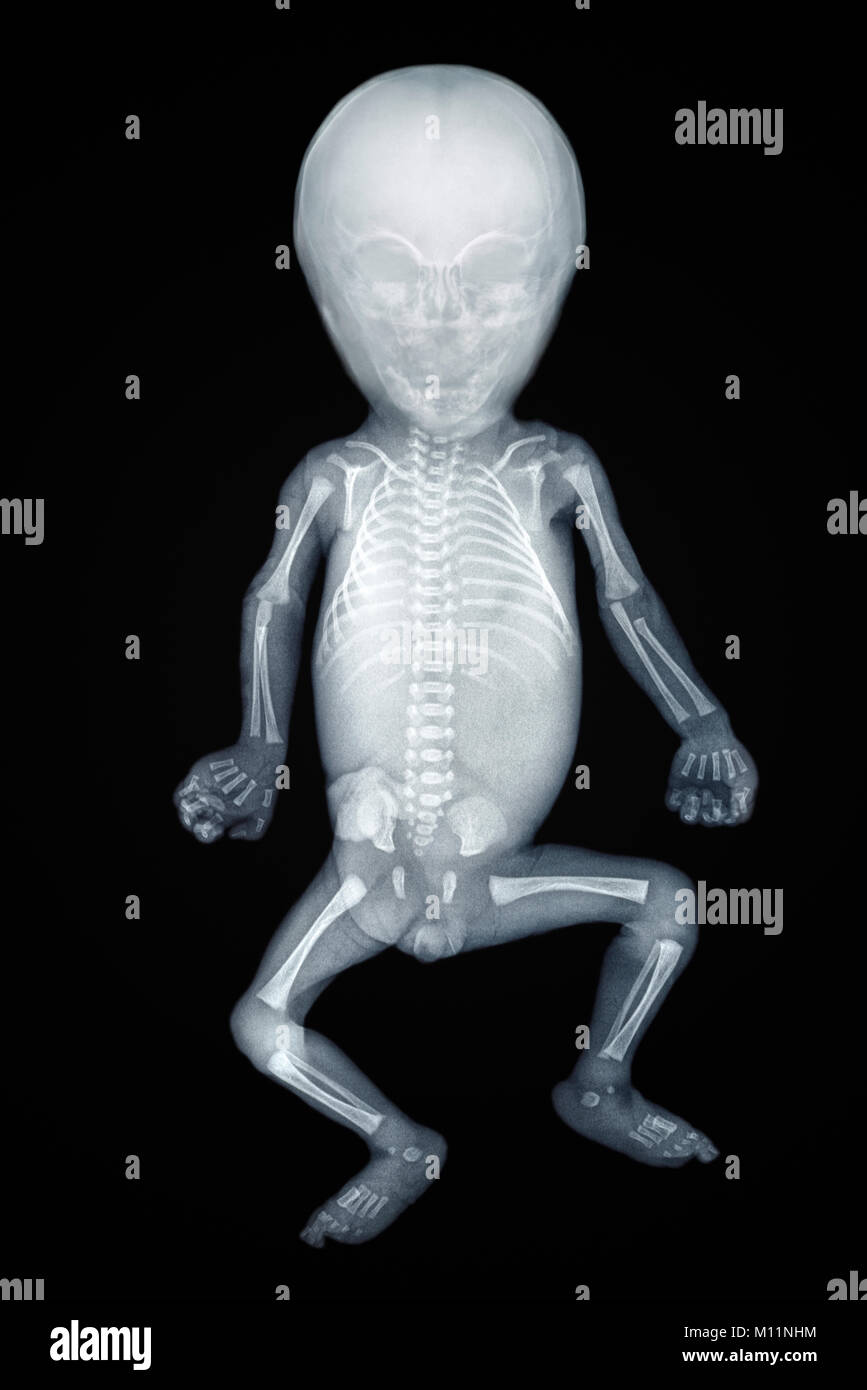 X-ray von einem Baby, Vorderansicht Stockfoto