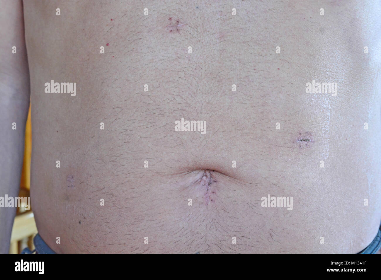 Männliche Patienten 14 Tage nach einem laparascopic cholocystectomy, einmal die Fäden entfernt wurden. Beachten Sie die Fast vernarbte unten links Stockfoto