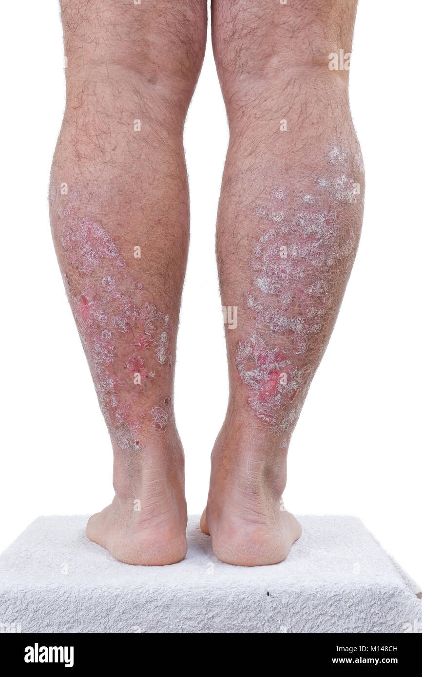 Chronische Dermatose Stockfotos Und -bilder Kaufen - Alamy