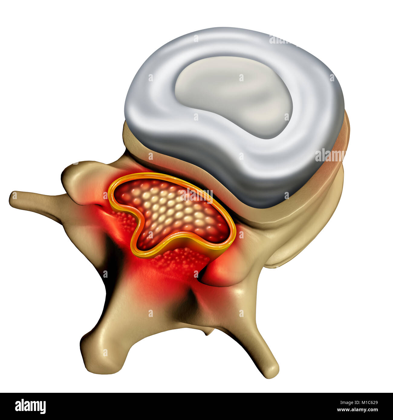 Spinale Stenose als degenerative Erkrankung der menschlichen Wirbelsäule verursachen komprimierte Wirbelsäule Nerven medizinisches Konzept als 3D-Darstellung. Stockfoto