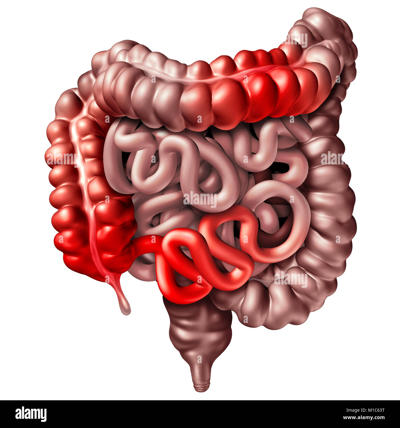 Crohns Krankheit oder Morbus Crohn Krankheit medizinische Konzept als menschliche Darm mit Entzündung Symptome Verstopfung verursachen als 3D-Darstellung. Stockfoto