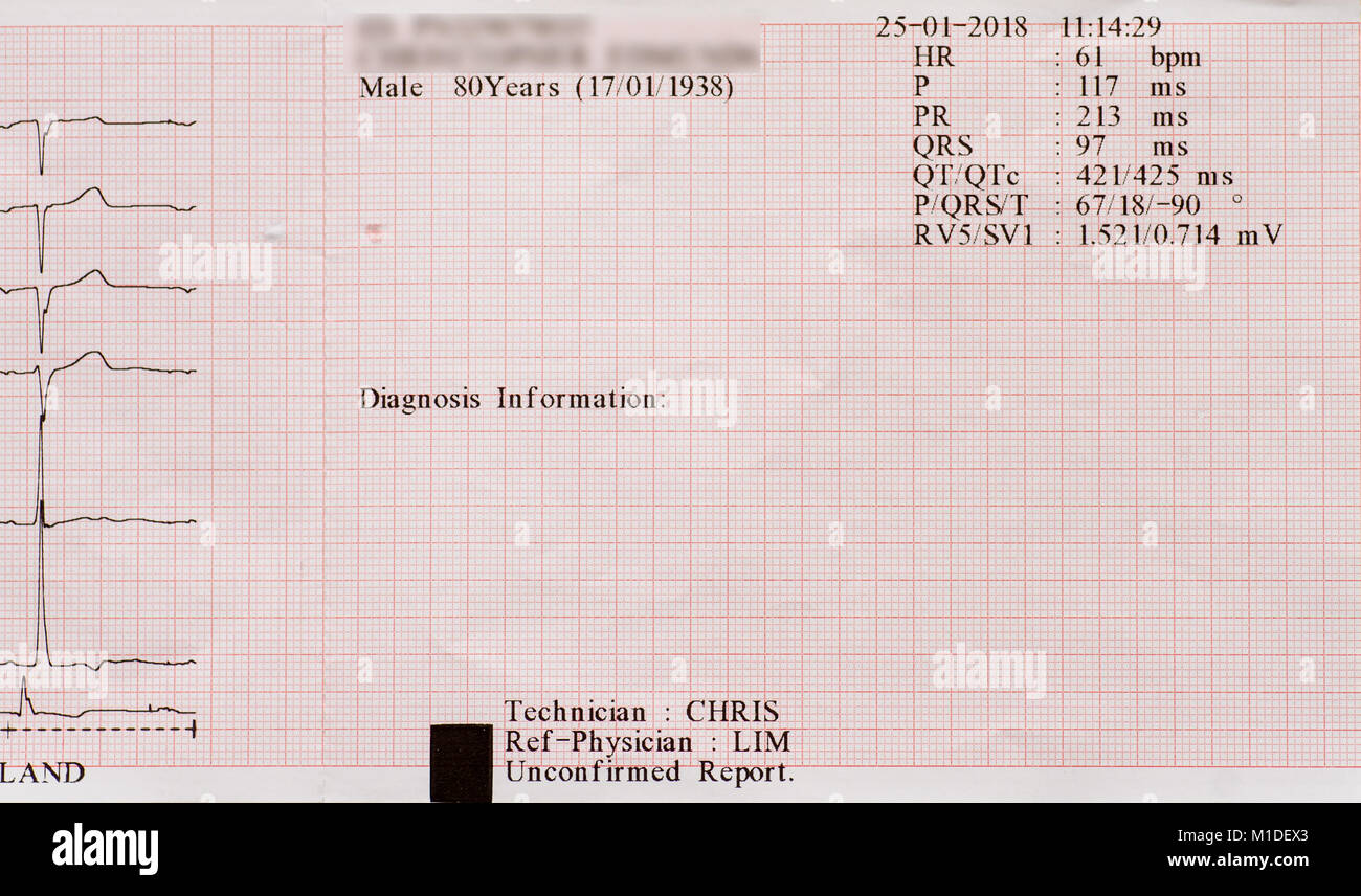 Ekg-Diagnose Informationen ausdrucken. Stockfoto