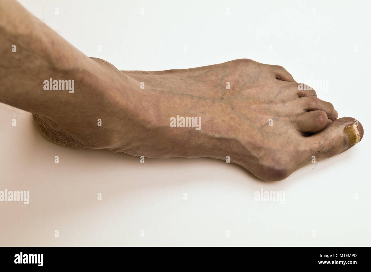Mißbildung der menschliche Fuß - Hallux valgus Stockfoto