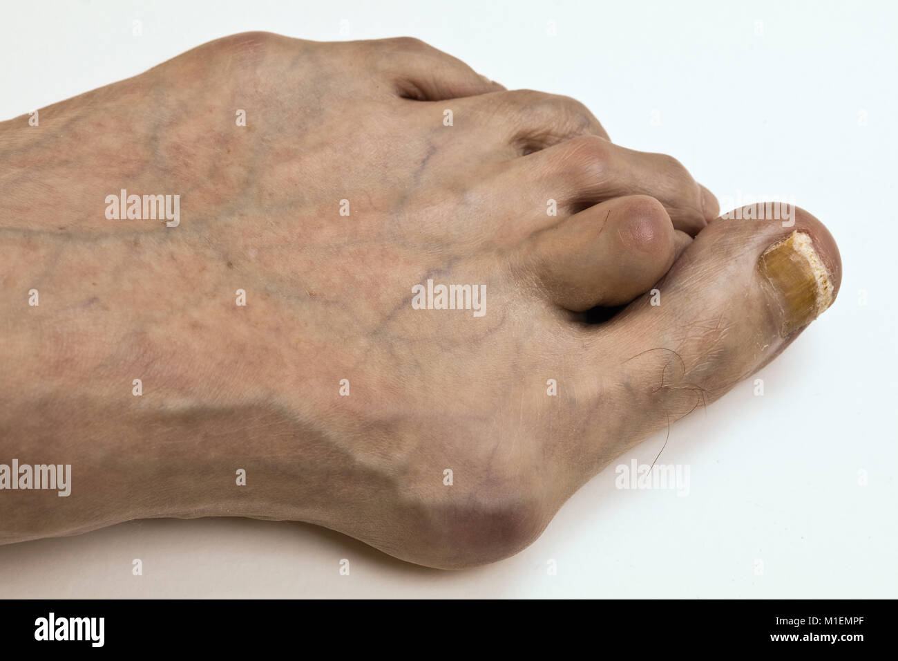 Mißbildung der menschliche Fuß - Hallux valgus, Detail Stockfoto