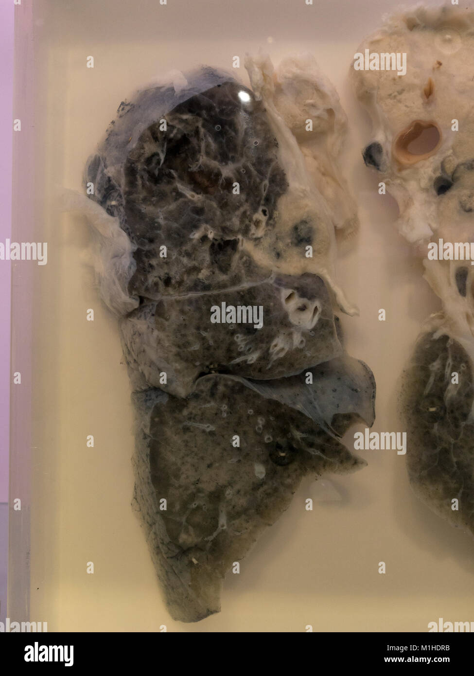 Ein Raucher Lunge Mit Karzinom Krebs Im National Museum Von Gesundheit Und Medizin Silver Spring Md Usa Stockfotografie Alamy