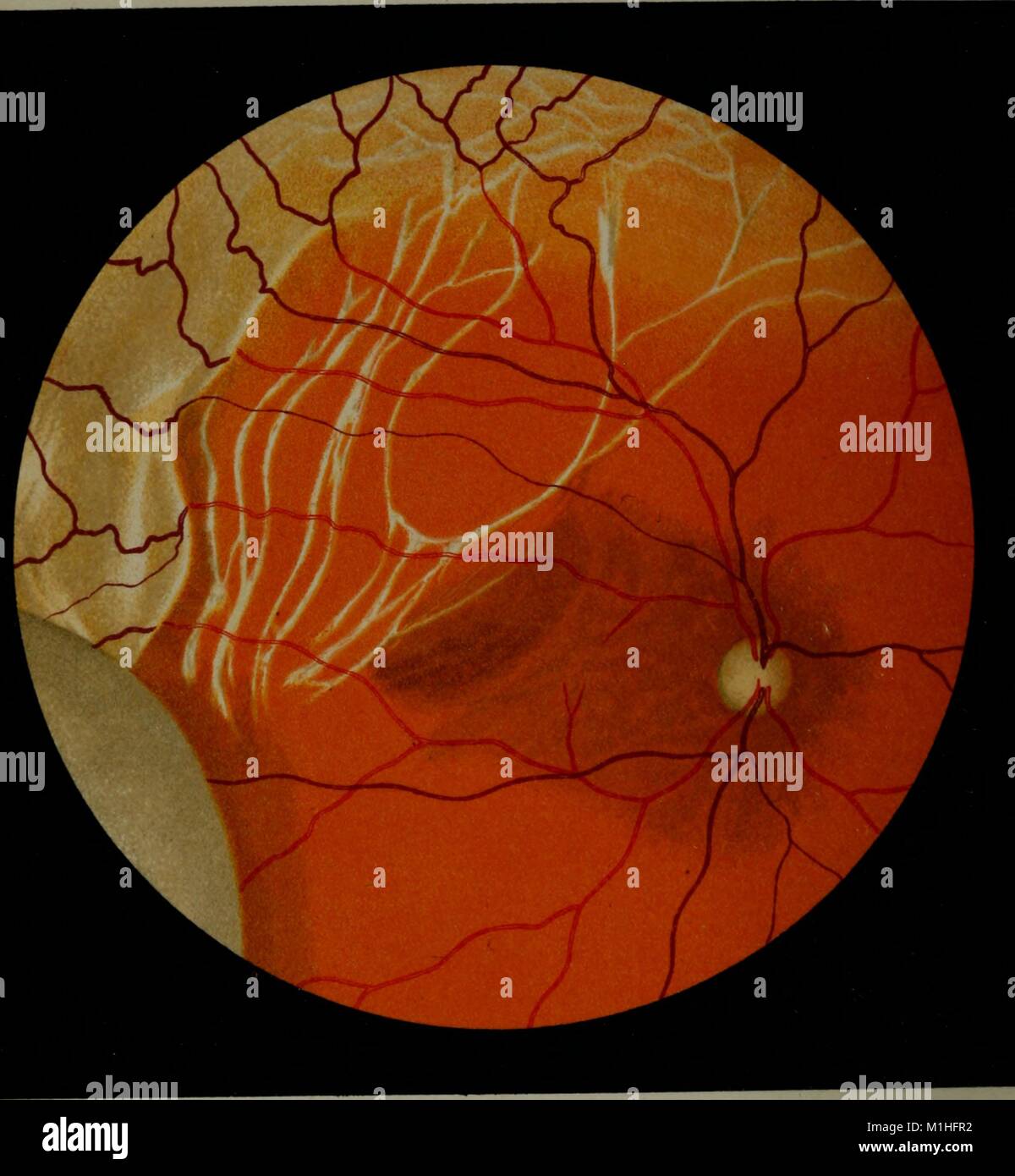 Farbe Diagramm Darstellung der retinalen Bands und Netzhautablösung ...