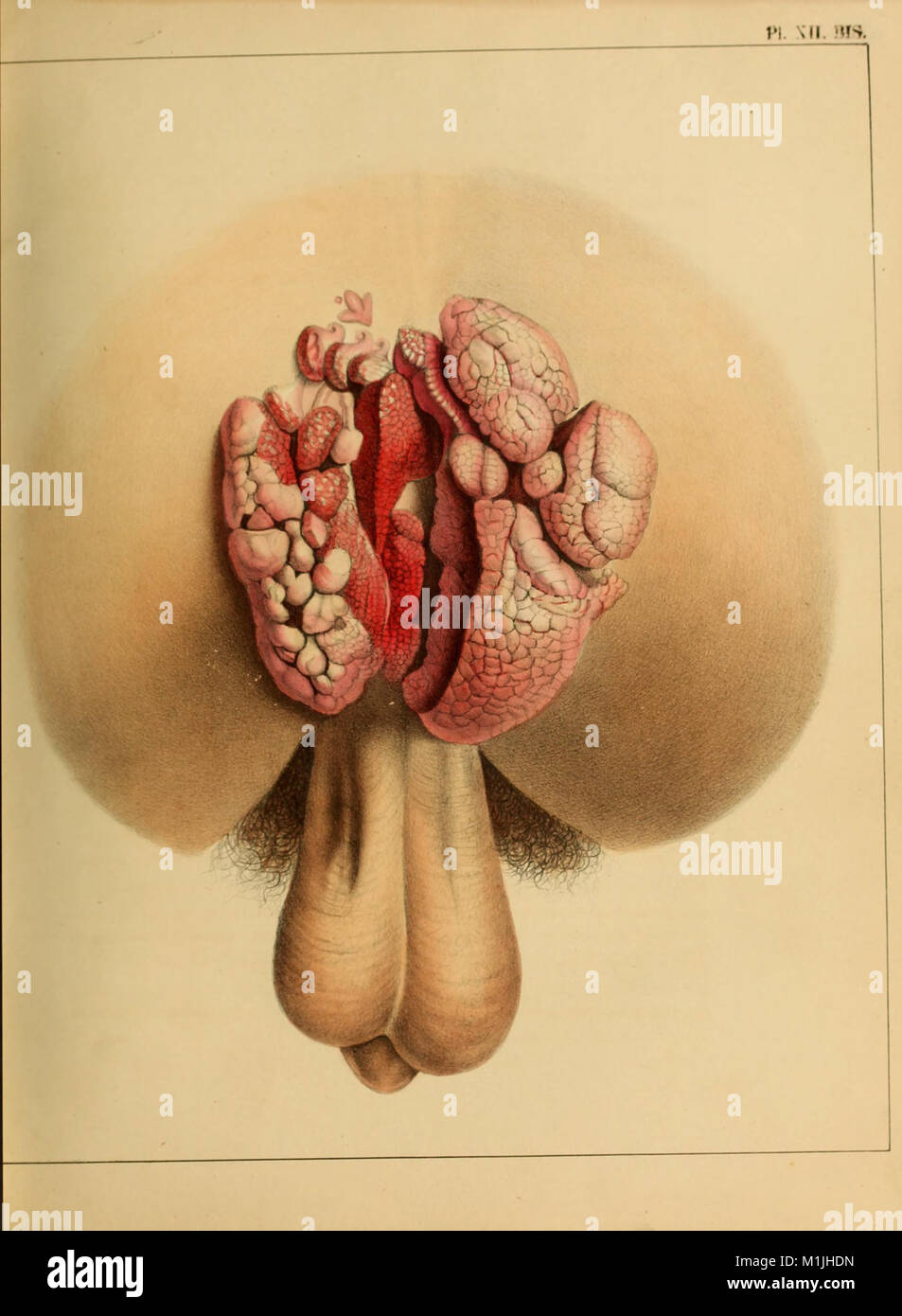 Eine vollständige praktische Arbeiten über die Natur und die Behandlung von Geschlechtskrankheiten und andere Neigungen der genito-harnorgane der männlichen und weiblichen (1848) (14764720624) Stockfoto