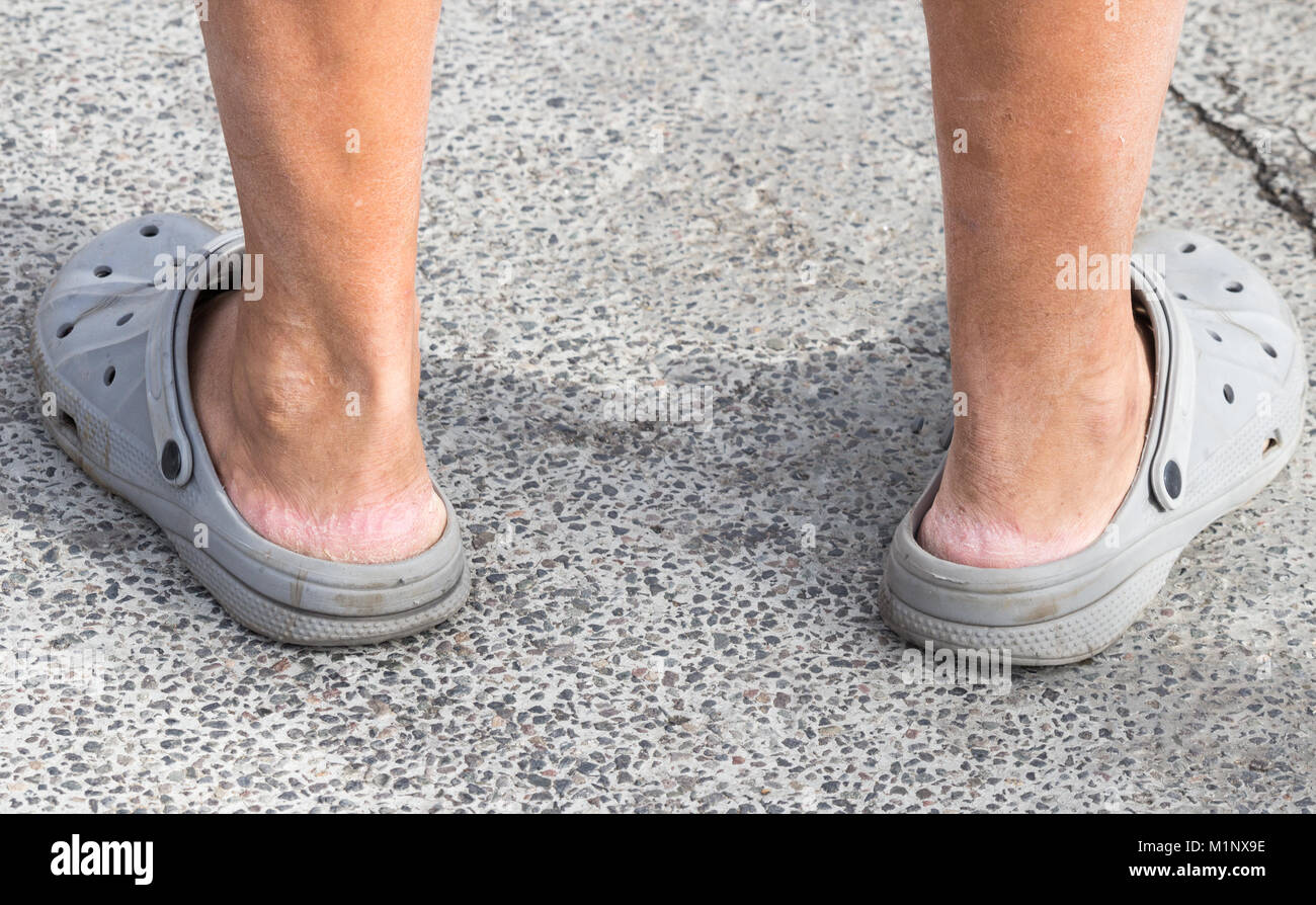 Crocs Sandalen. Person tragen Crocs ohne Socken. Rissige Haut an Ferse Stockfoto