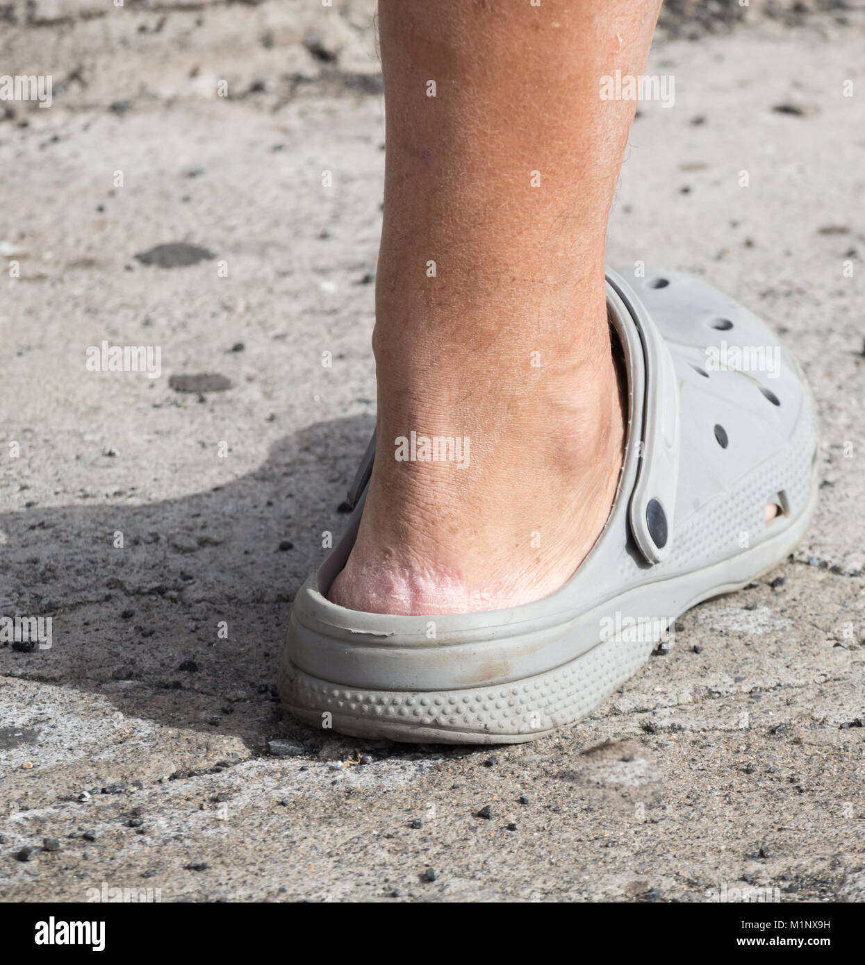 Crocs Sandalen. Person tragen Crocs ohne Socken. Rissige Haut an Ferse Stockfoto