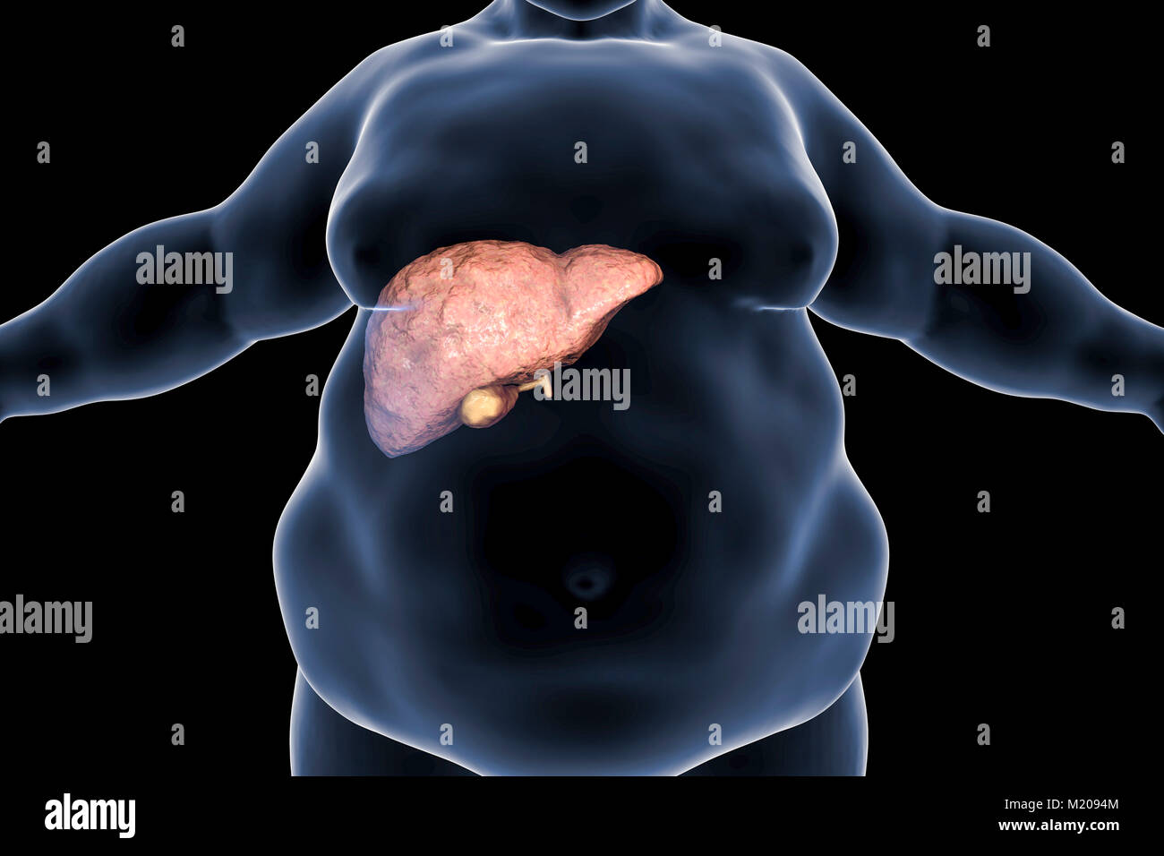 Fettleber Bei Adiposen Person Konzeptionelle Darstellung Fettleber Ist Haufig Im Zusammenhang Mit Alkohol Oder Das Metabolische Syndrom Diabetes Bluthochdruck Und Ubergewicht Kann Aber Auch Durch Eine Von Vielen Ursachen Sein Fettleber Ist