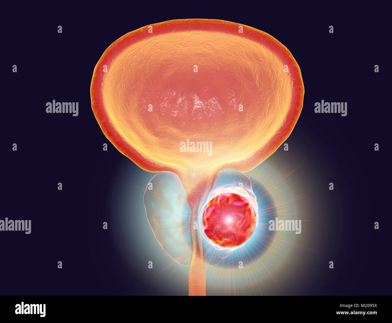 Die Behandlung des Prostatakrebses, konzeptionelle Darstellung. Stockfoto
