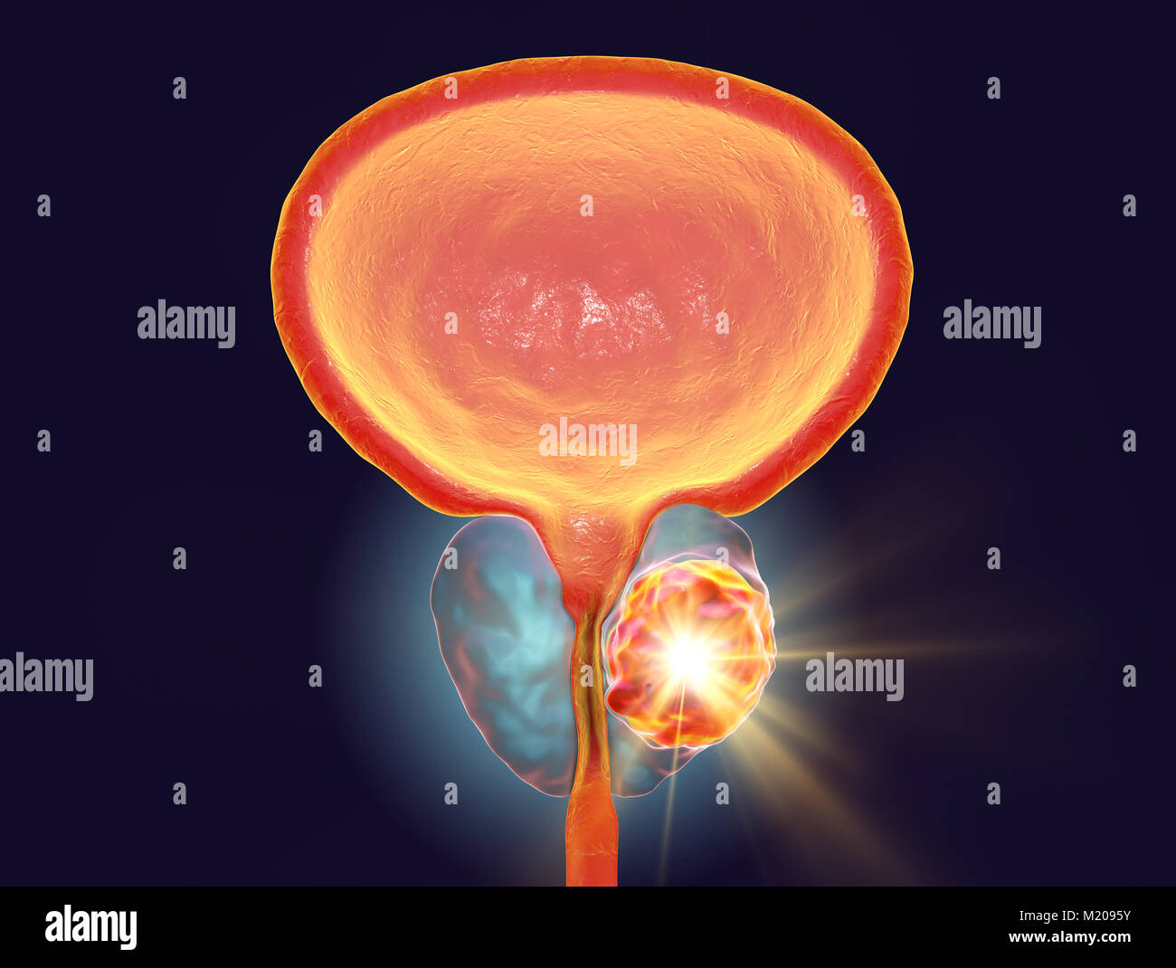 Die Behandlung des Prostatakrebses, konzeptionelle Darstellung. Stockfoto