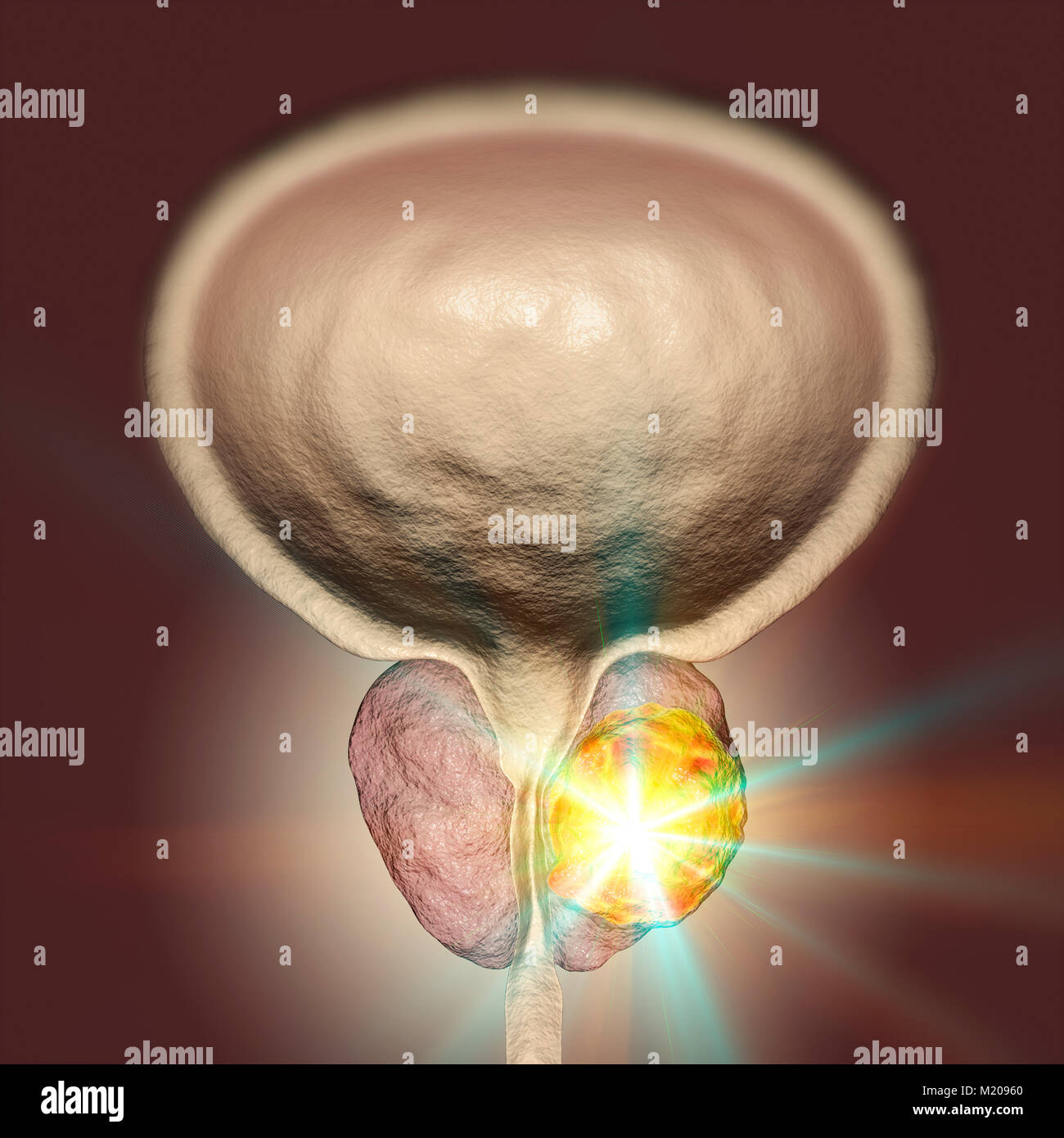 Die Behandlung des Prostatakrebses, konzeptionelle Darstellung. Stockfoto
