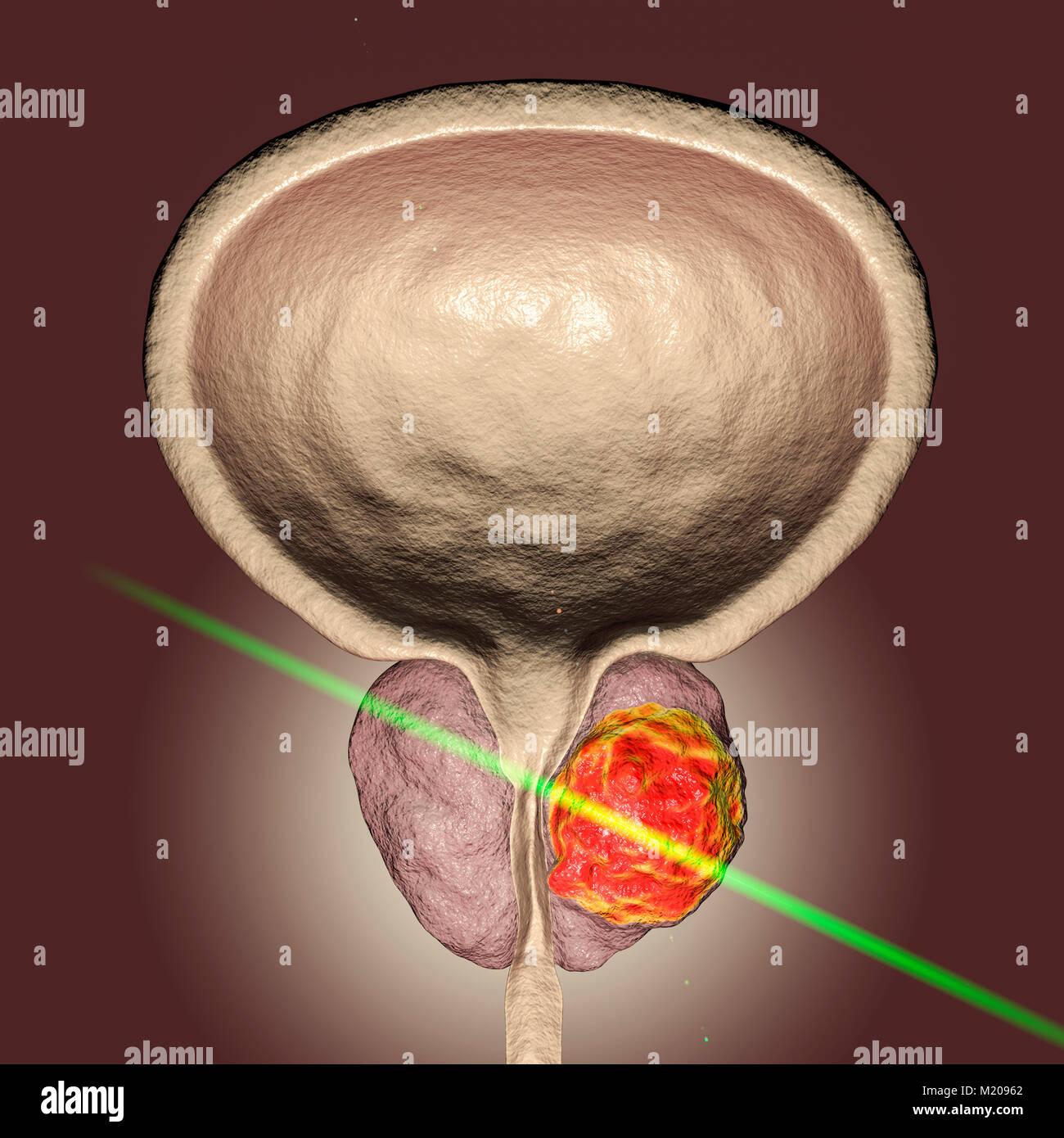 Laserotherapy des Prostatakrebses, konzeptionelle Darstellung. Stockfoto