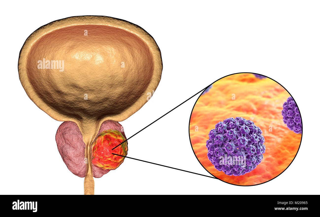 Virale Ätiologie von Prostatakrebs. Konzeptionelle Abbildung: Humane Papillomviren (HPV) infizieren und Prostata Krebs Entwicklung. Stockfoto