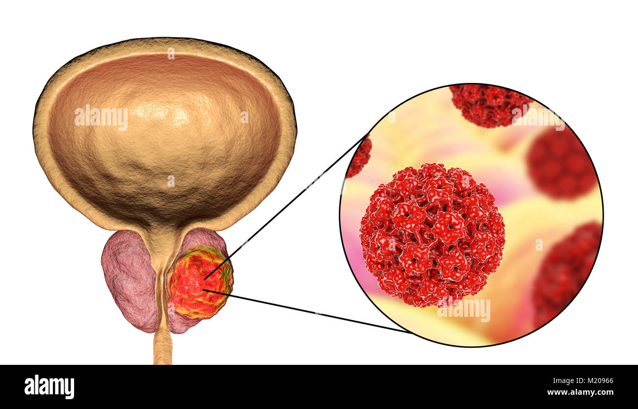 Virale Ätiologie von Prostatakrebs. Konzeptionelle Abbildung: Humane Papillomviren (HPV) infizieren und Prostata Krebs Entwicklung. Stockfoto