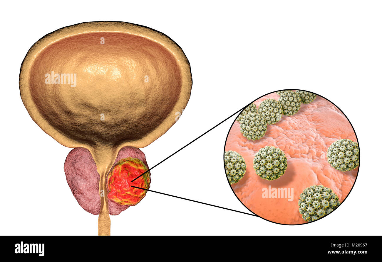 Virale Ätiologie von Prostatakrebs. Konzeptionelle Abbildung: Humane Papillomviren (HPV) infizieren und Prostata Krebs Entwicklung. Stockfoto