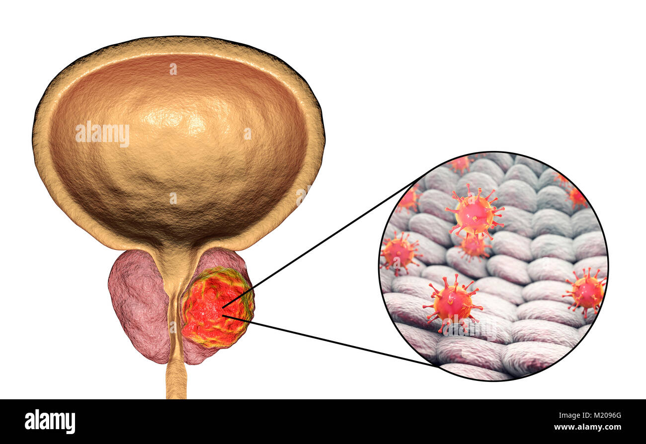 Virale Ätiologie von Prostatakrebs. Konzeptionelle Abbildung mit Viren infizieren, Prostata und verursachen Krebs Entwicklung. Stockfoto
