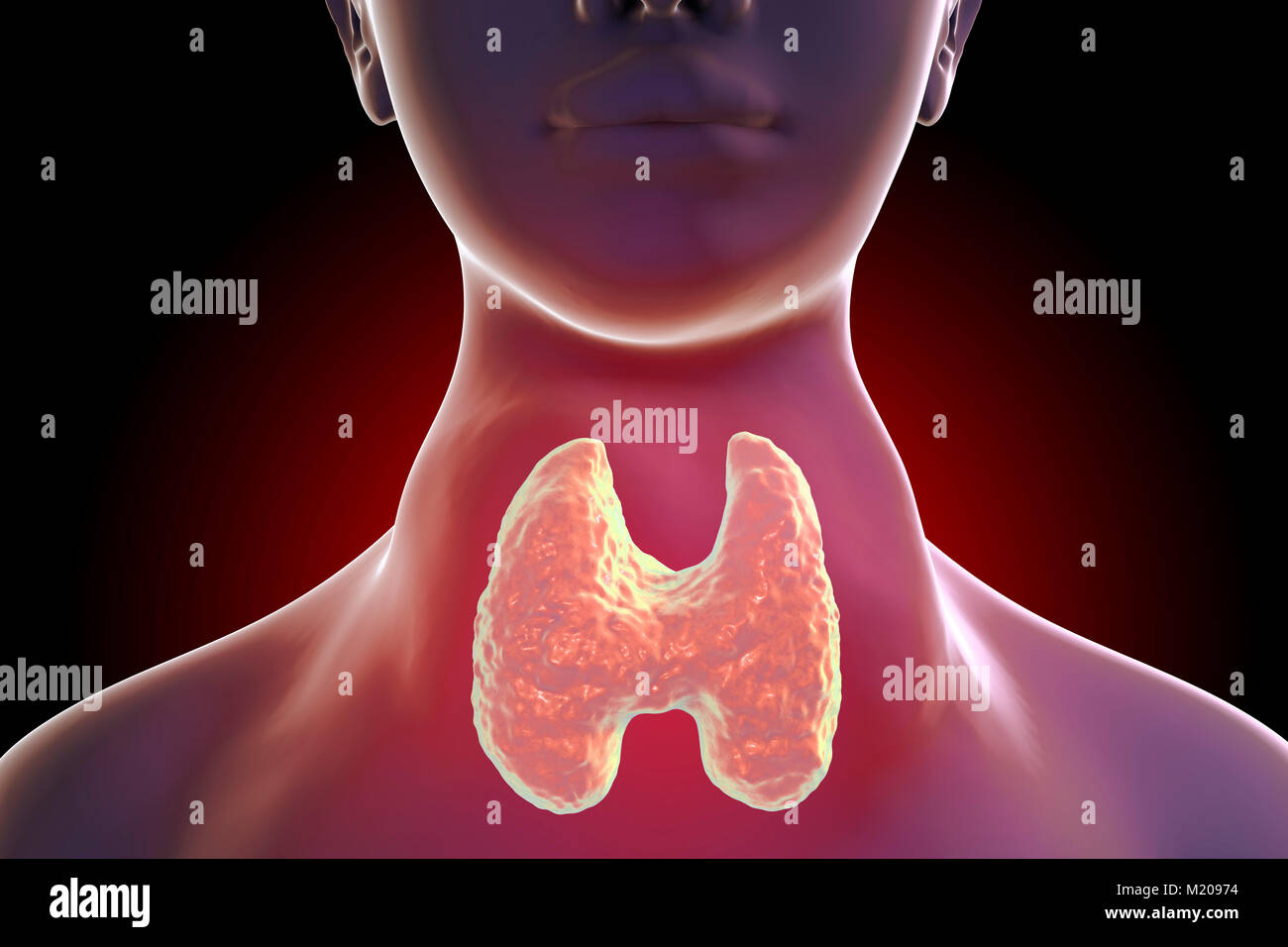 Thyrotoxic Struma (Kropf), Illustration. Kropf (geschwollenen Hals) gesehen auf eine Frau, die Patienten leiden unter einer Überfunktion der Schilddrüse. Ein kropf wird durch die Vergrößerung der Schilddrüse verursacht und können in der Größe von einem kleinen Klumpen zu einem enormen Schwellung variieren. Überaktivität der Schilddrüse, auch bekannt als thyreotoxikose, Ergebnisse in der Überproduktion der Schilddrüsenhormone im Körper. Dies kann in Symptome reichen von Gewicht Verlust führen und verstärkter Appetit zu Herzen zittern und Muskelschwund. Zu den Behandlungen zählen Drogen schilddrüseproduktion oder chirurgische Entfernung der Schilddrüse zu begrenzen. Stockfoto