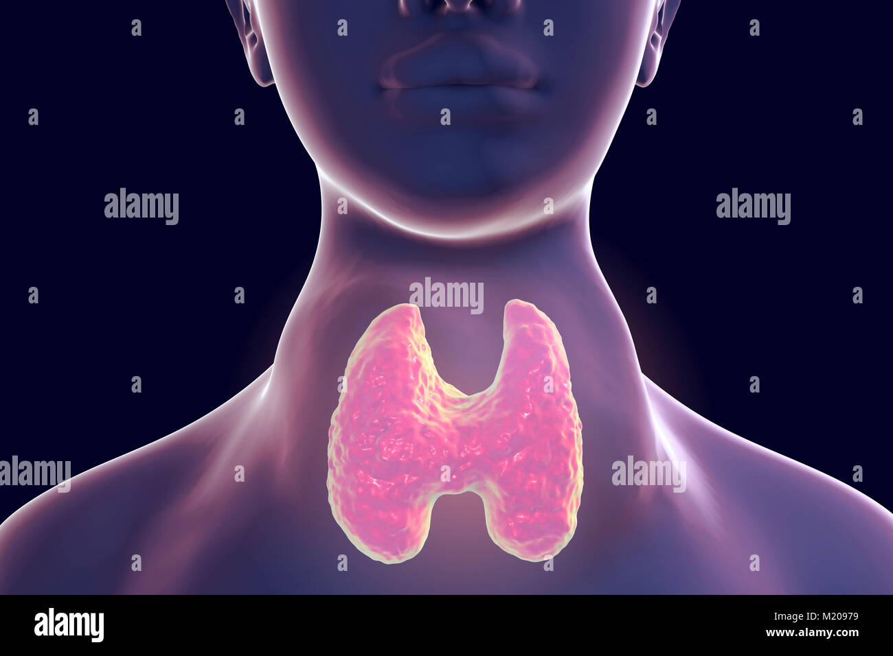 Thyrotoxic Struma (Kropf), Illustration. Kropf (geschwollenen Hals) gesehen auf eine Frau, die Patienten leiden unter einer Überfunktion der Schilddrüse. Ein kropf wird durch die Vergrößerung der Schilddrüse verursacht und können in der Größe von einem kleinen Klumpen zu einem enormen Schwellung variieren. Überaktivität der Schilddrüse, auch bekannt als thyreotoxikose, Ergebnisse in der Überproduktion der Schilddrüsenhormone im Körper. Dies kann in Symptome reichen von Gewicht Verlust führen und verstärkter Appetit zu Herzen zittern und Muskelschwund. Zu den Behandlungen zählen Drogen schilddrüseproduktion oder chirurgische Entfernung der Schilddrüse zu begrenzen. Stockfoto