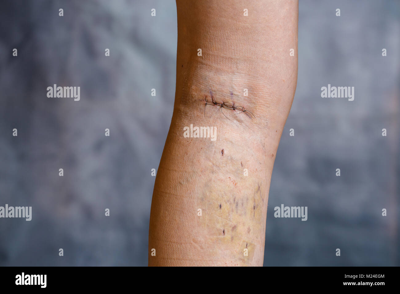 Womans Bein nach Krampfadern Chirurgie, mit sichtbaren chirurgisches Nahtmaterial (Stiche) und Wunden am Bein. Eine kurative Behandlung, ästhetische Verfahren, thro Stockfoto