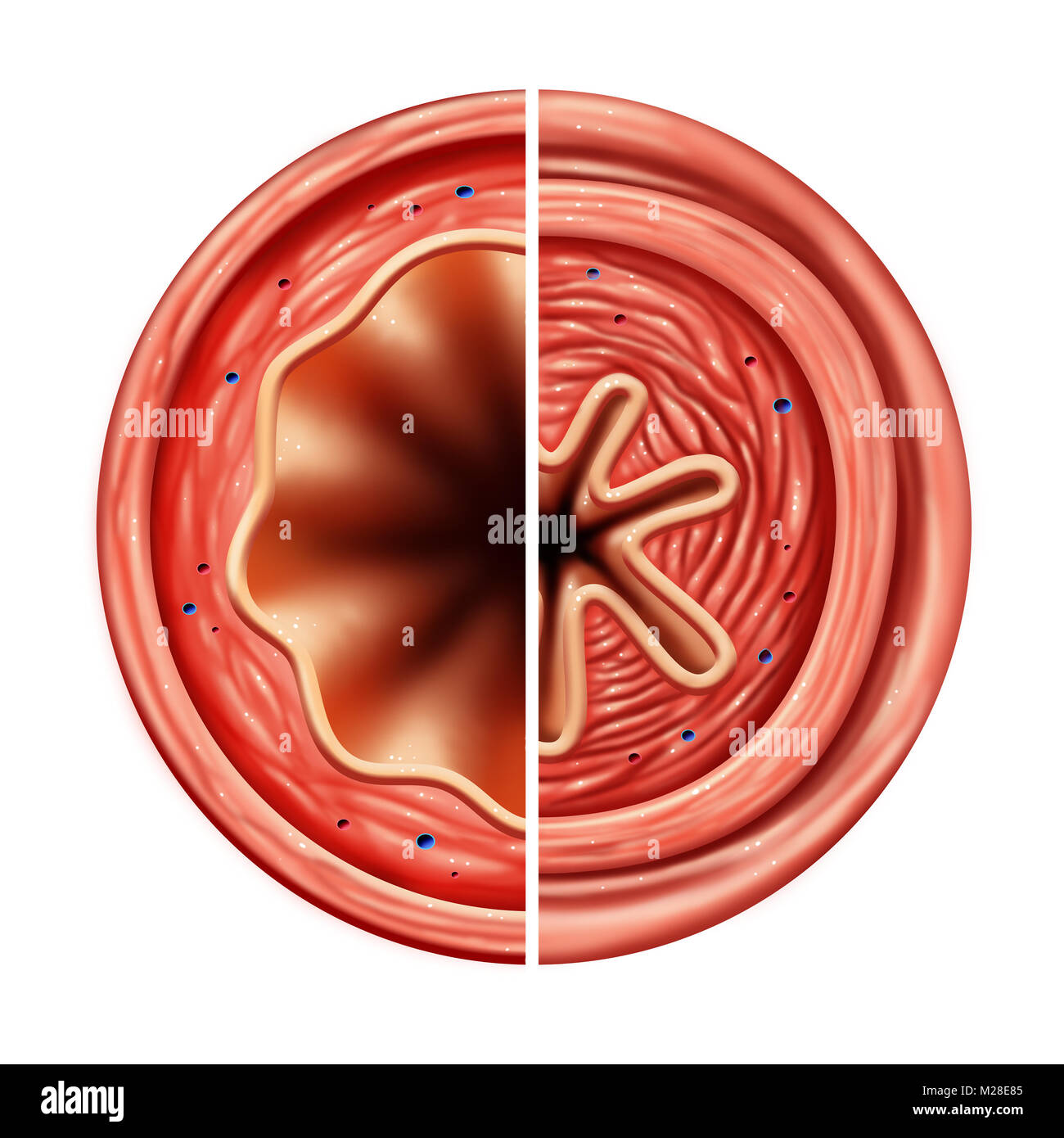 Asthma bronchiale Rohr verengt Atemproblem Konzept durch die atemmuskulatur Anzug und Schwellungen der Luftweg. Stockfoto