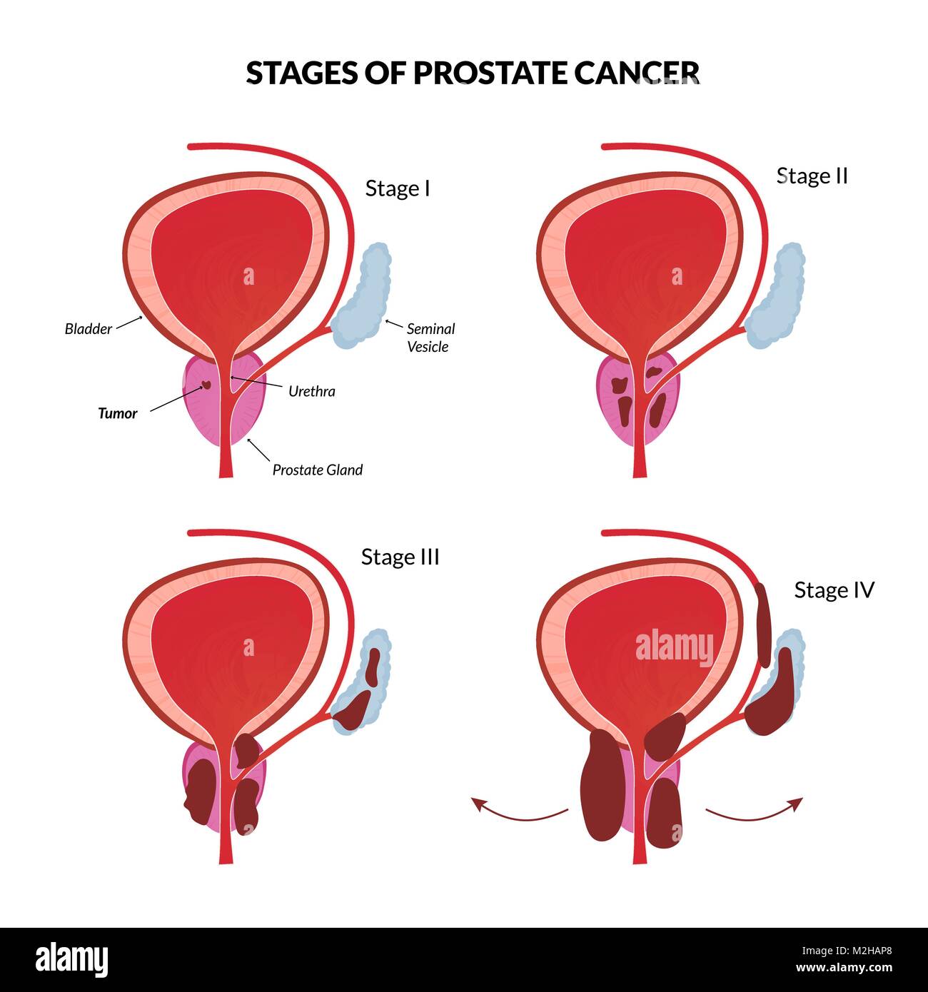 Vier Stufen der Prostata bösartige Tumor ausbreiten. Stock Vektor