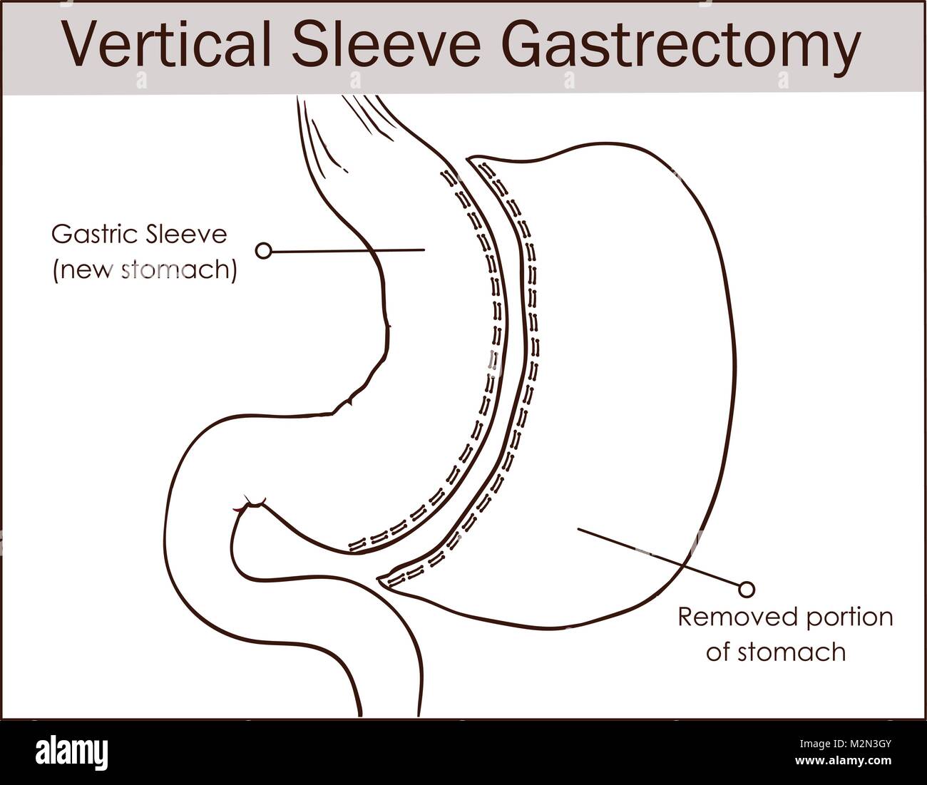Sleeve gastrectomy procedure Fotos und Bildmaterial in hoher Auflösung Alamy