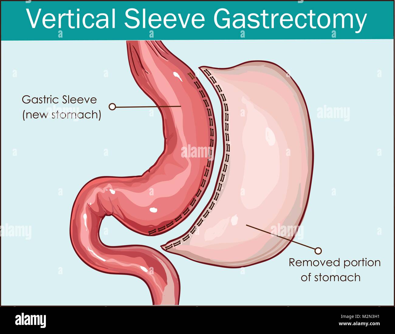 Vertikale sleeve gastrektomie Fotos und Bildmaterial in hoher