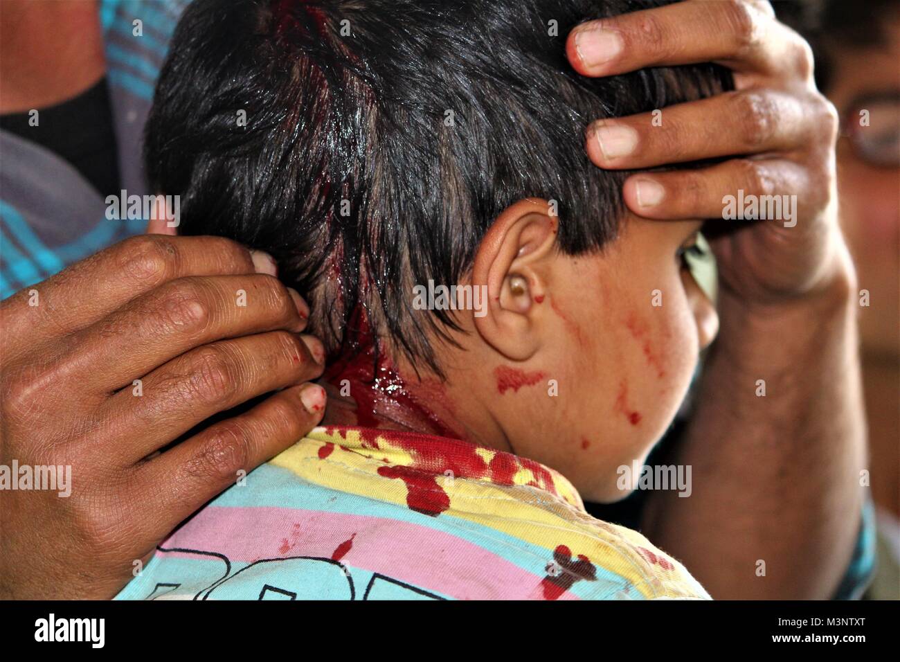 Kind Head Injury in Indien protestieren, Baramulla, Kaschmir, Indien, Asien Stockfoto
