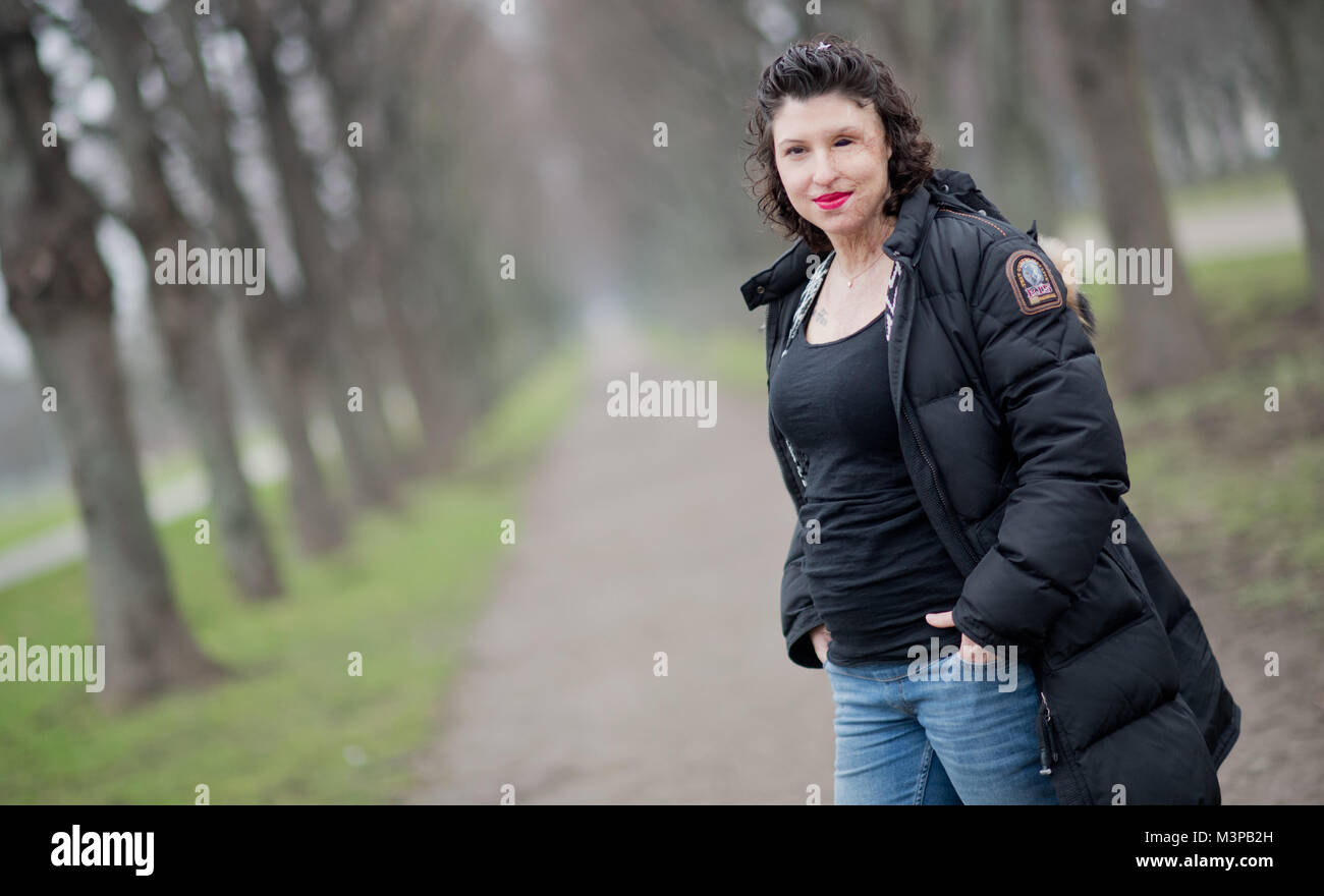 Hannover Deutschland 5 Februar 2018 Vanessa Muenstermann Hat Ihr Bild In Hannover Deutschland Vom 5 Februar 2018 Aufgenommen Vor Zwei Jahren Ihr Ex Freund Ihr Mit Schwefelsaure Angegriffen Und Ihr Fur Das Leben