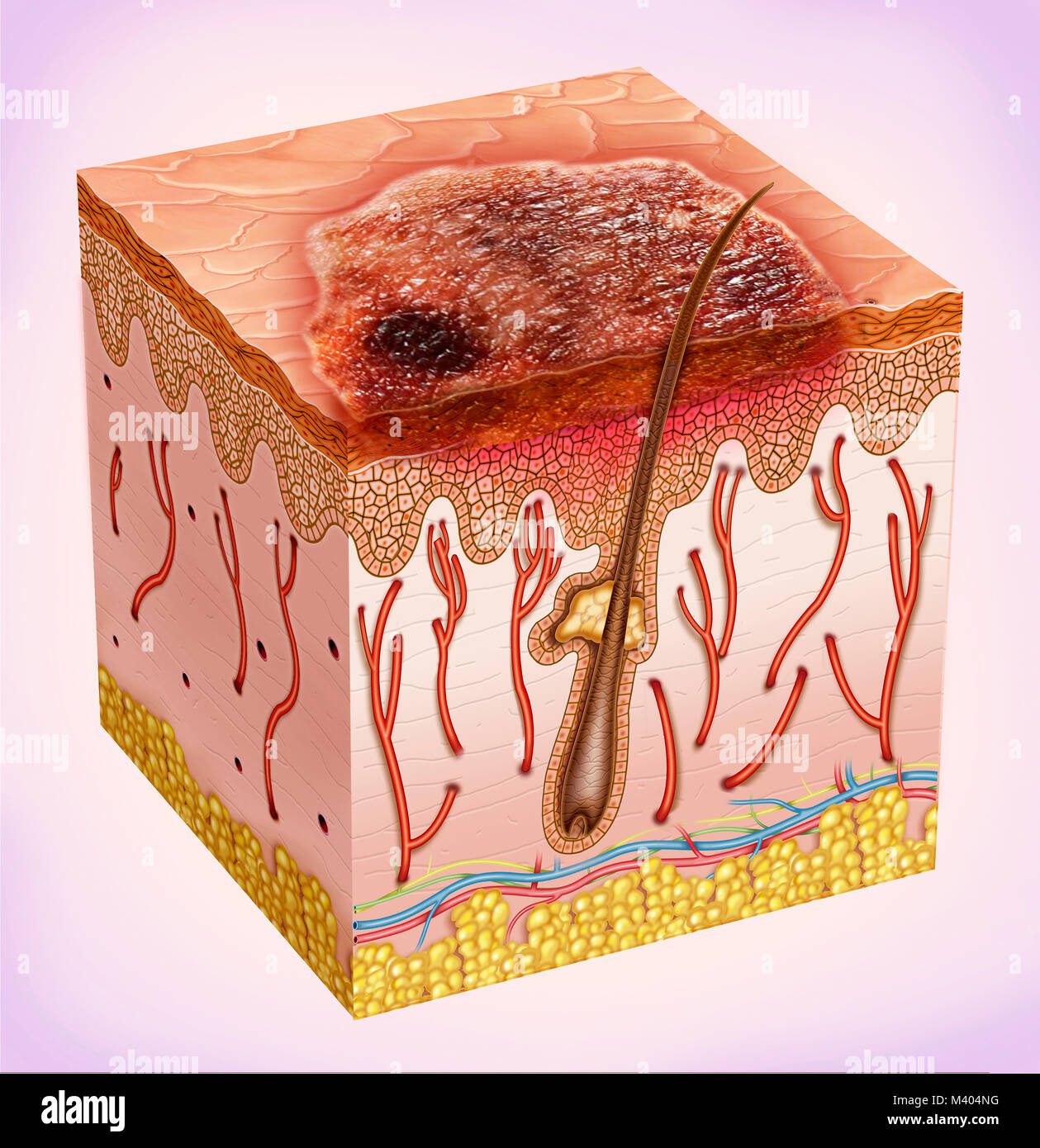 Haut Segment durch Hautkrebs betroffen ist fast immer ein langsames Wachstum in Form von Krebs, die häufigsten sind: Schuppige, Melanom. Diese treten auf der Haut, das ist Stockfoto