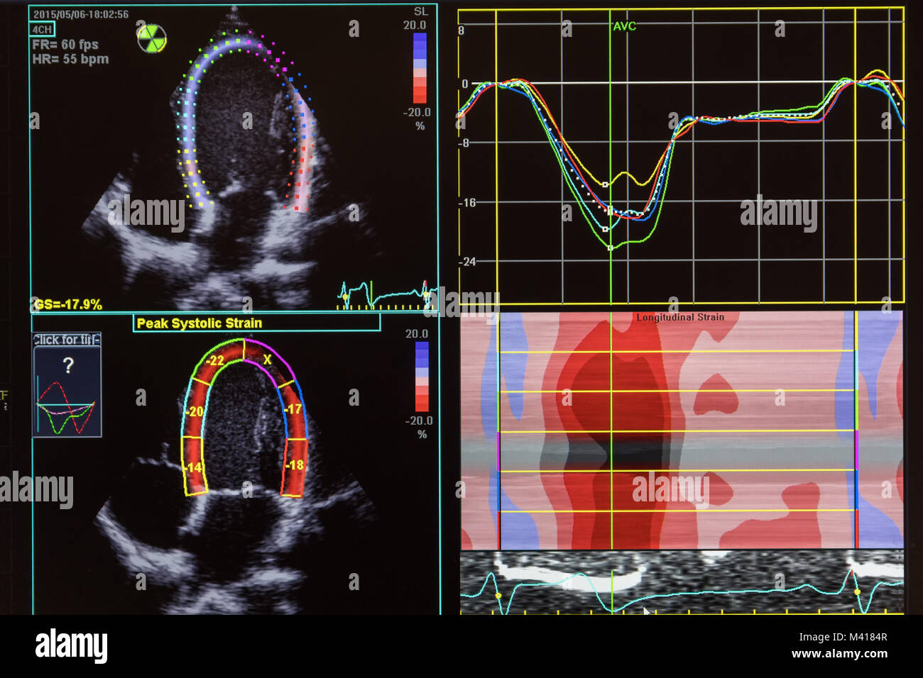 Herz Ultraschall Bild auf einem Bildschirm. Stockfoto