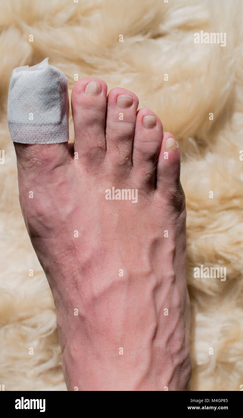 Toe-Betrieb auf die große Zehe im Krankenhaus Stockfoto