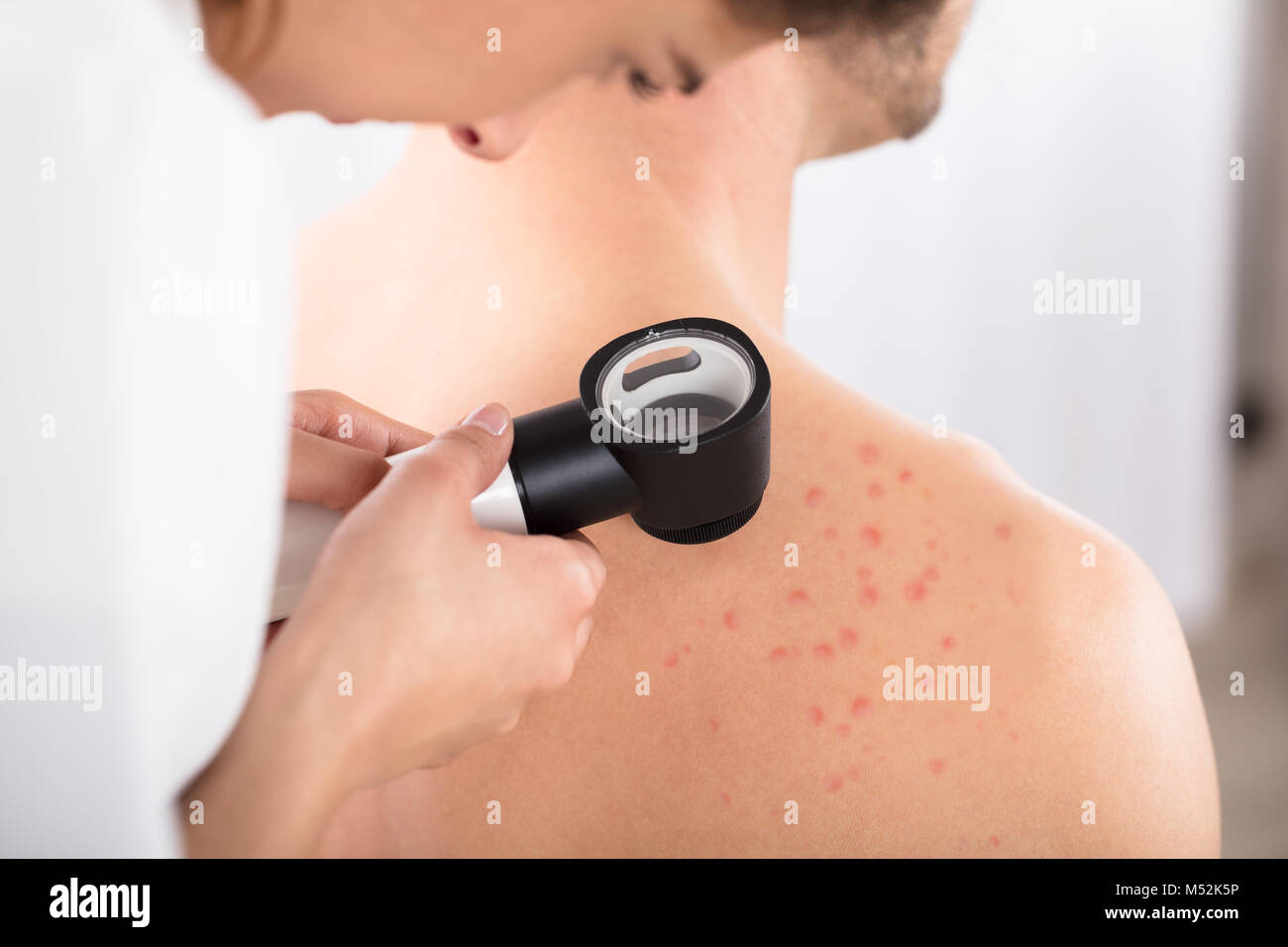 Weibliche Dermatologen untersuchen Acnes des Patienten mit Dermatoskop Stockfoto