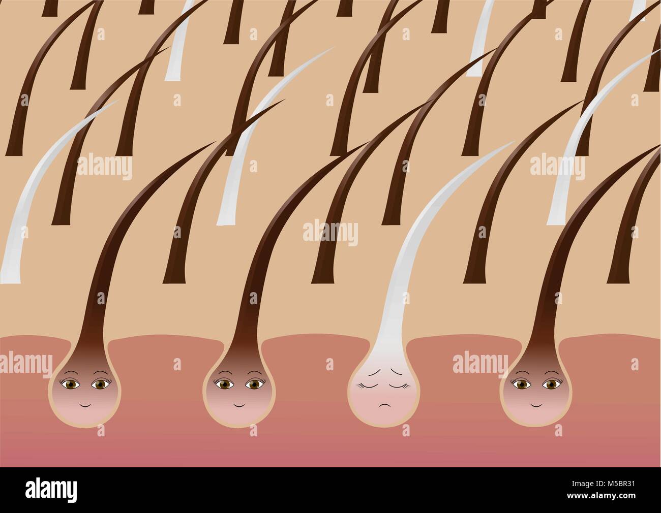 Cartoon Haarfollikel auf der Kopfhaut leiden Pigmentierung Stock Vektor