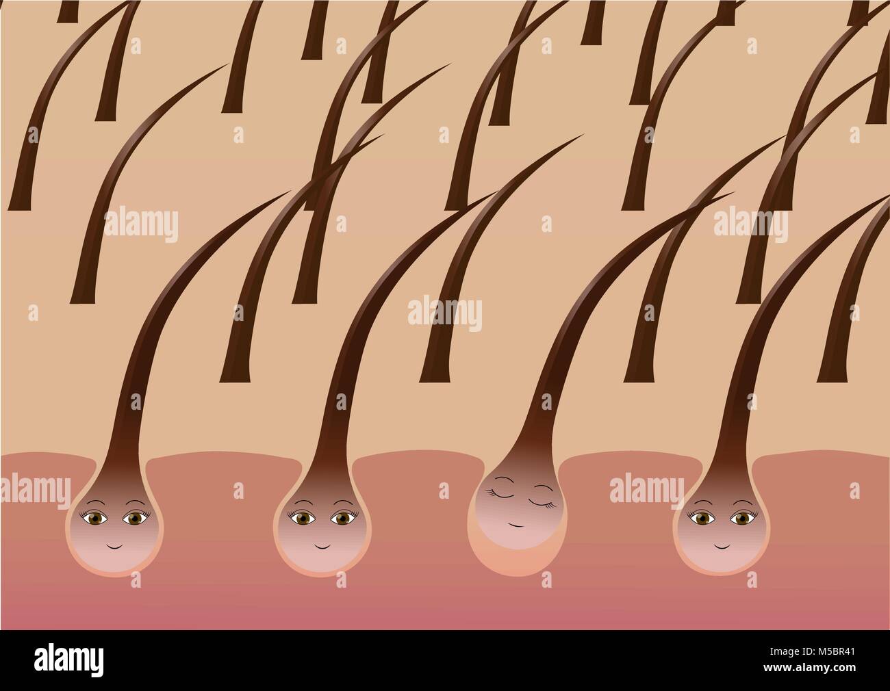 Cartoon Haarfollikel auf der Kopfhaut leiden unter Verlust Stock Vektor